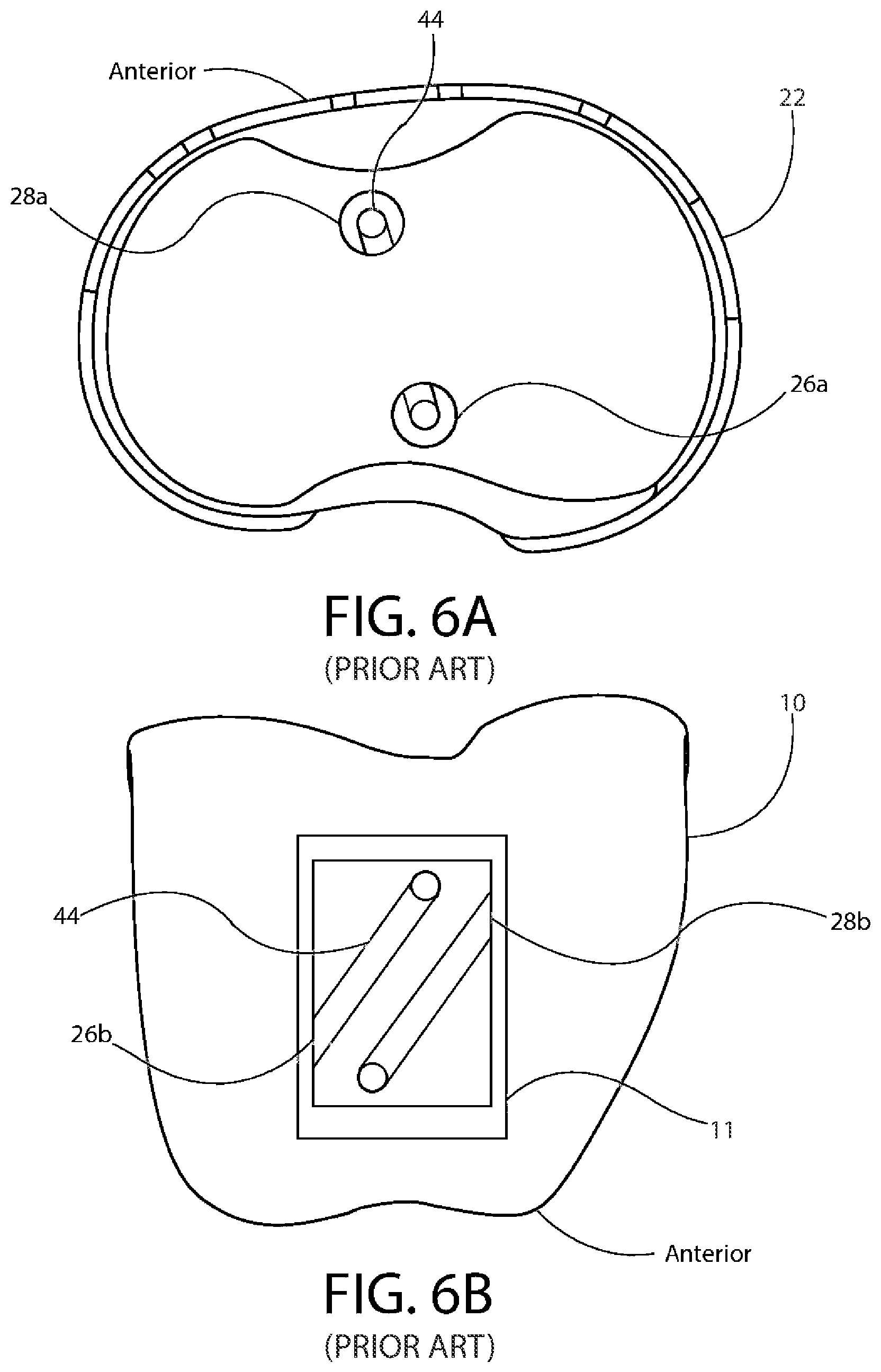 Patent US12611310 Figure 6 – Modular artificial knee system