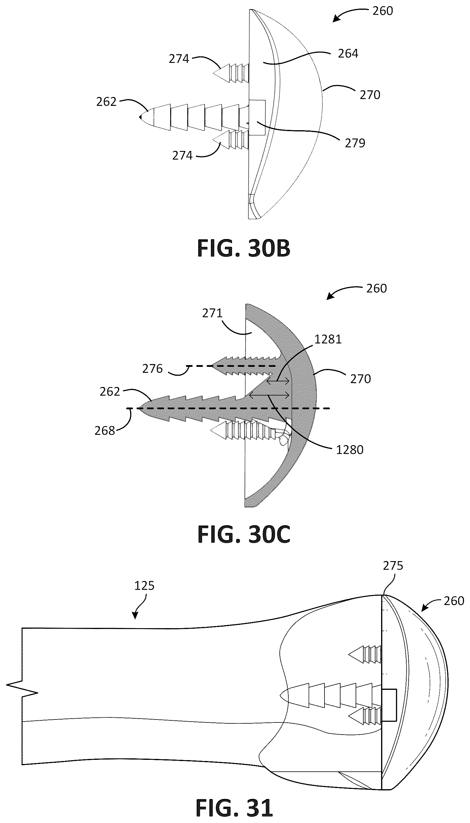 Patent US12611311 Figure 17 – Metatarsal arthroplasty devices, systems, and methods