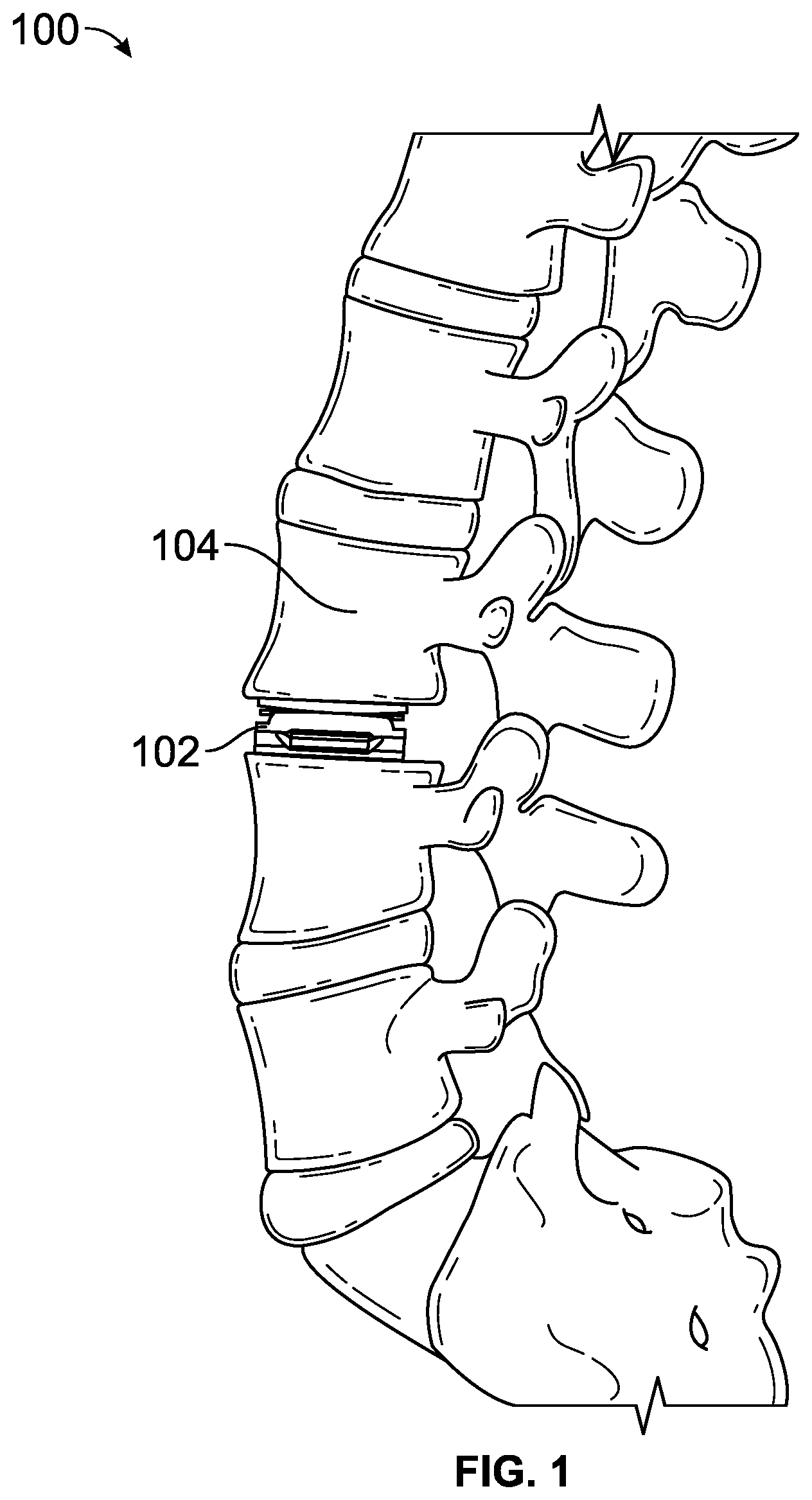 Patent US12611313 Figure 1 – Minimally invasive compliant devices for total lumbar disc replacement