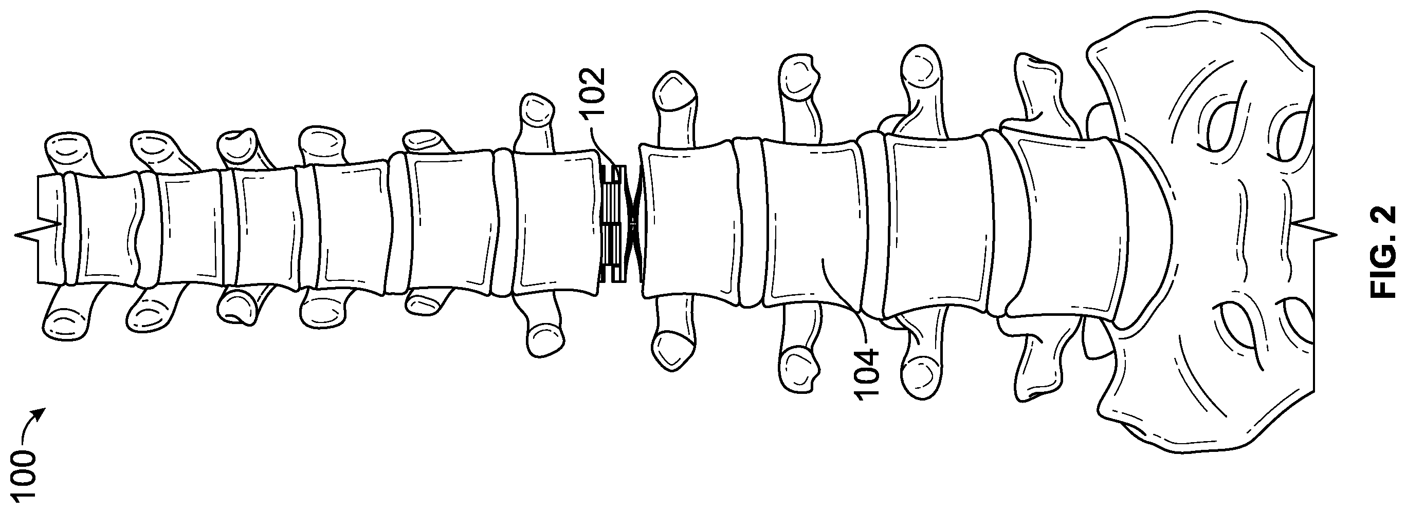 Patent US12611313 Figure 2 – Minimally invasive compliant devices for total lumbar disc replacement