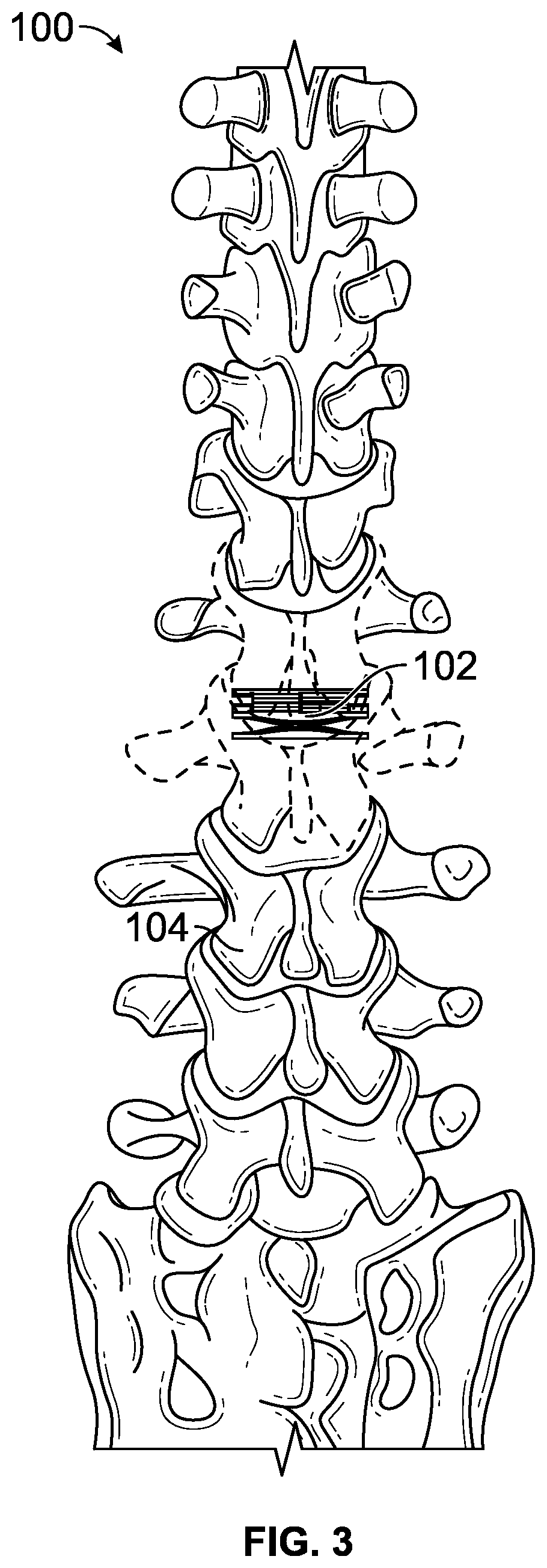 Patent US12611313 Figure 3 – Minimally invasive compliant devices for total lumbar disc replacement