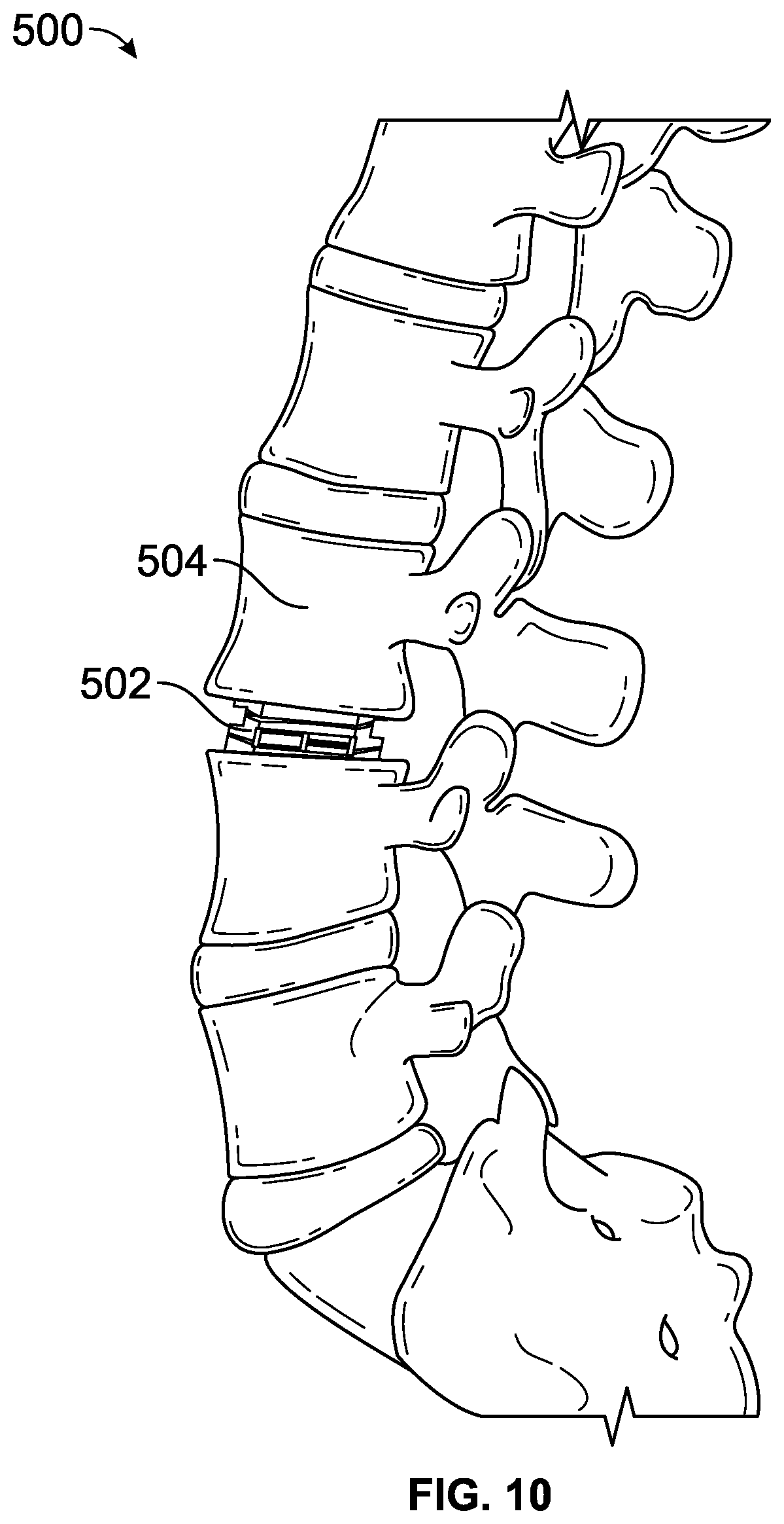 Patent US12611313 Figure 10 – Minimally invasive compliant devices for total lumbar disc replacement