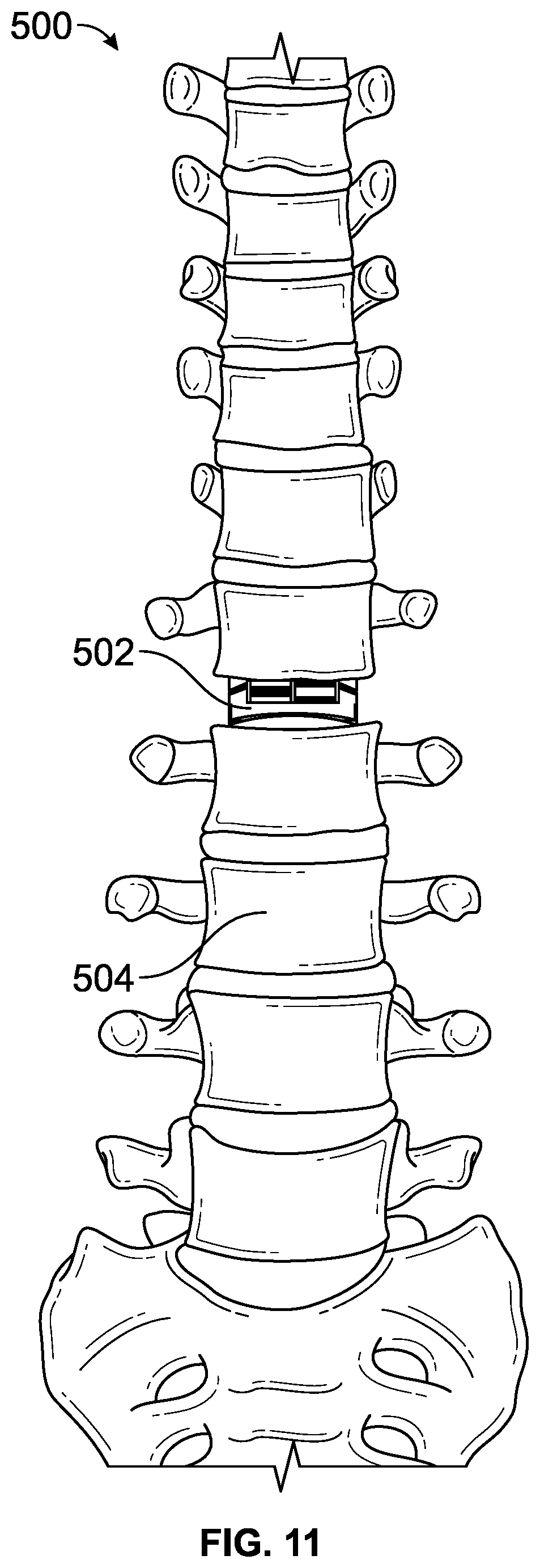 Patent US12611313 Figure 11 – Minimally invasive compliant devices for total lumbar disc replacement