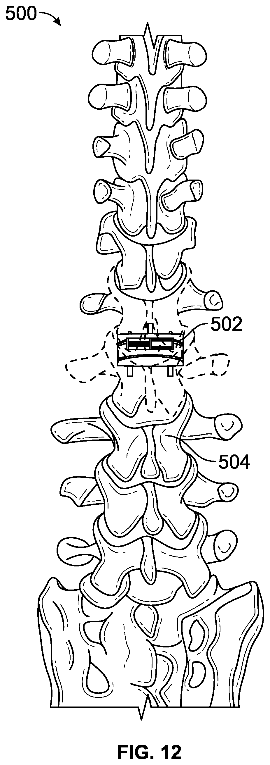 Patent US12611313 Figure 12 – Minimally invasive compliant devices for total lumbar disc replacement