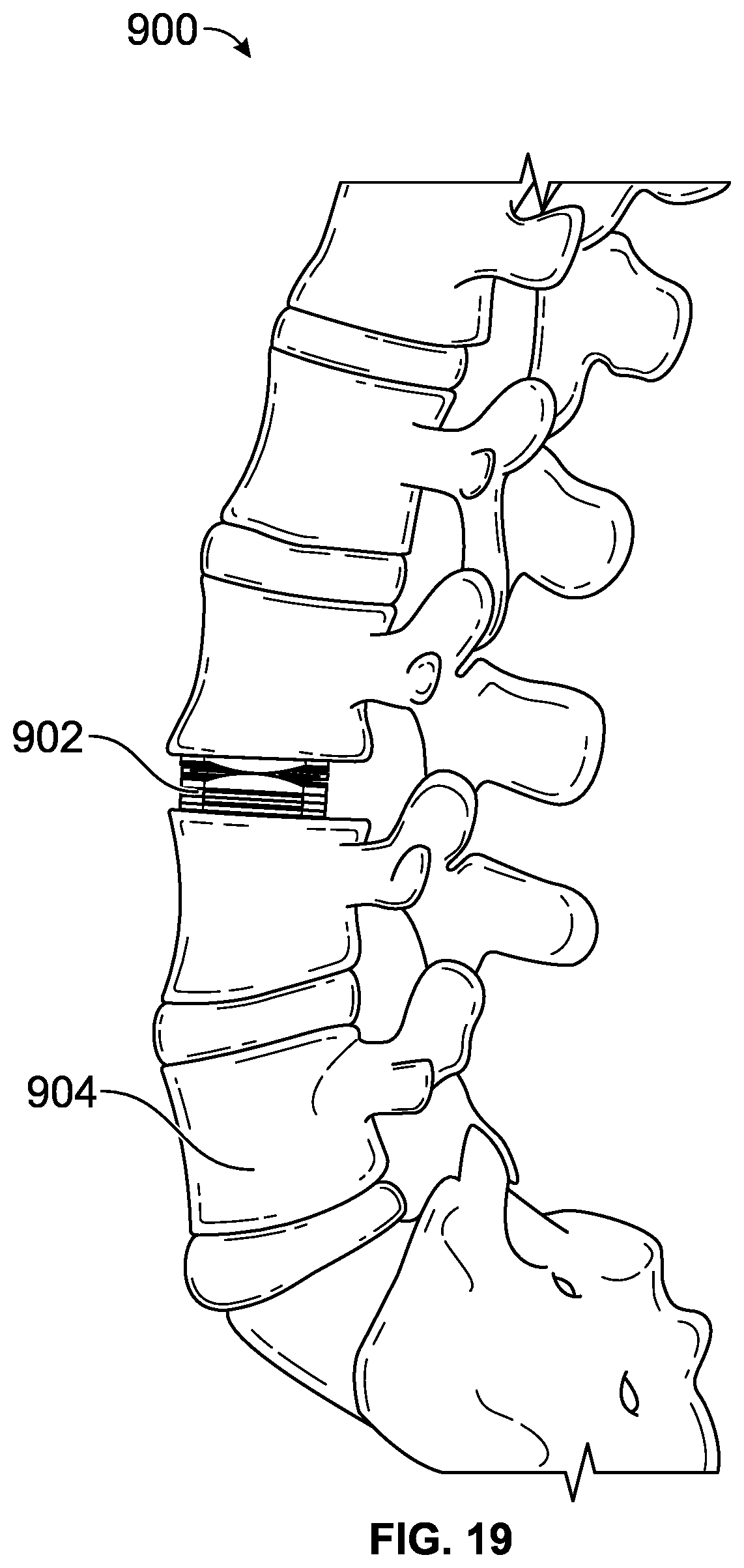 Patent US12611313 Figure 19 – Minimally invasive compliant devices for total lumbar disc replacement