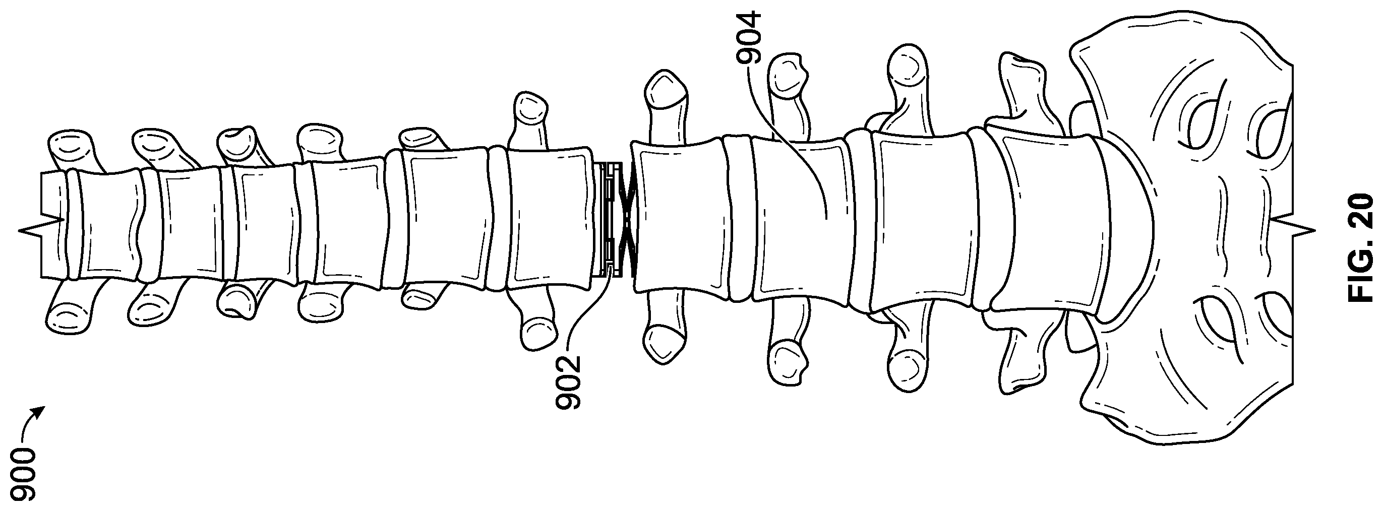 Patent US12611313 Figure 20 – Minimally invasive compliant devices for total lumbar disc replacement