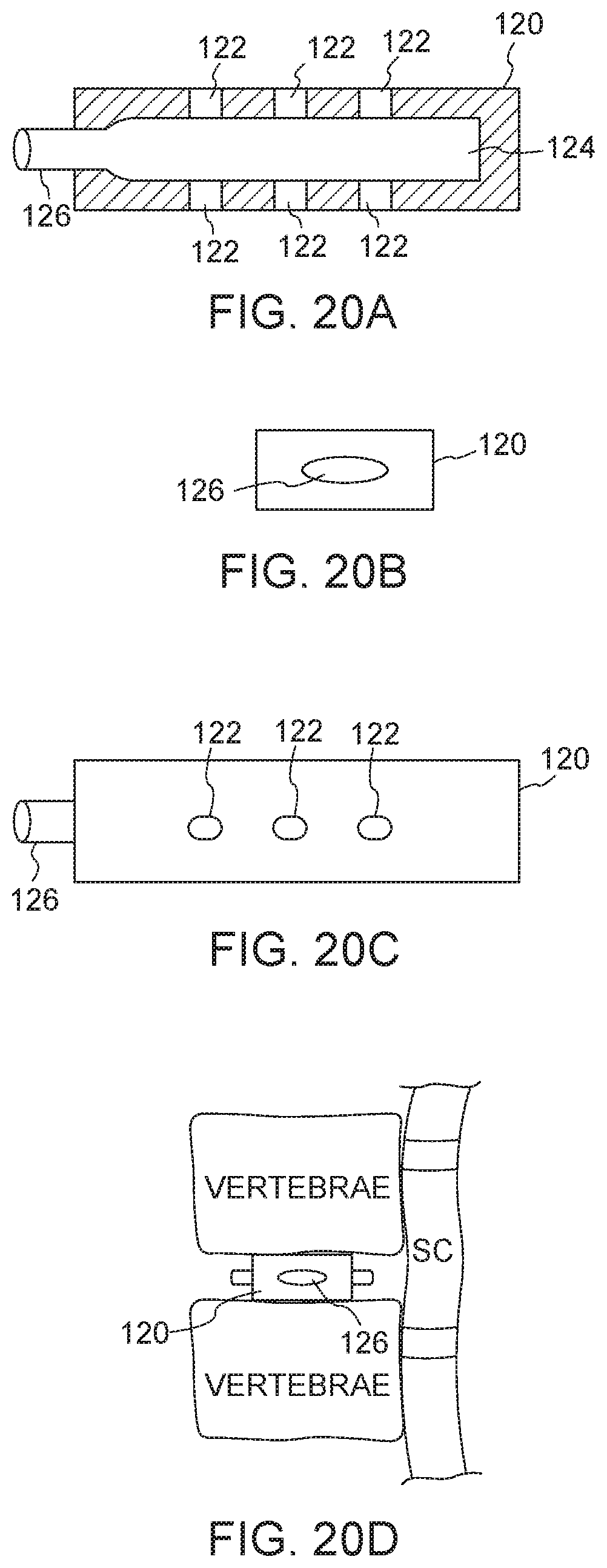 Patent US12611315 Figure 12 – Bone graft delivery system and method for using same