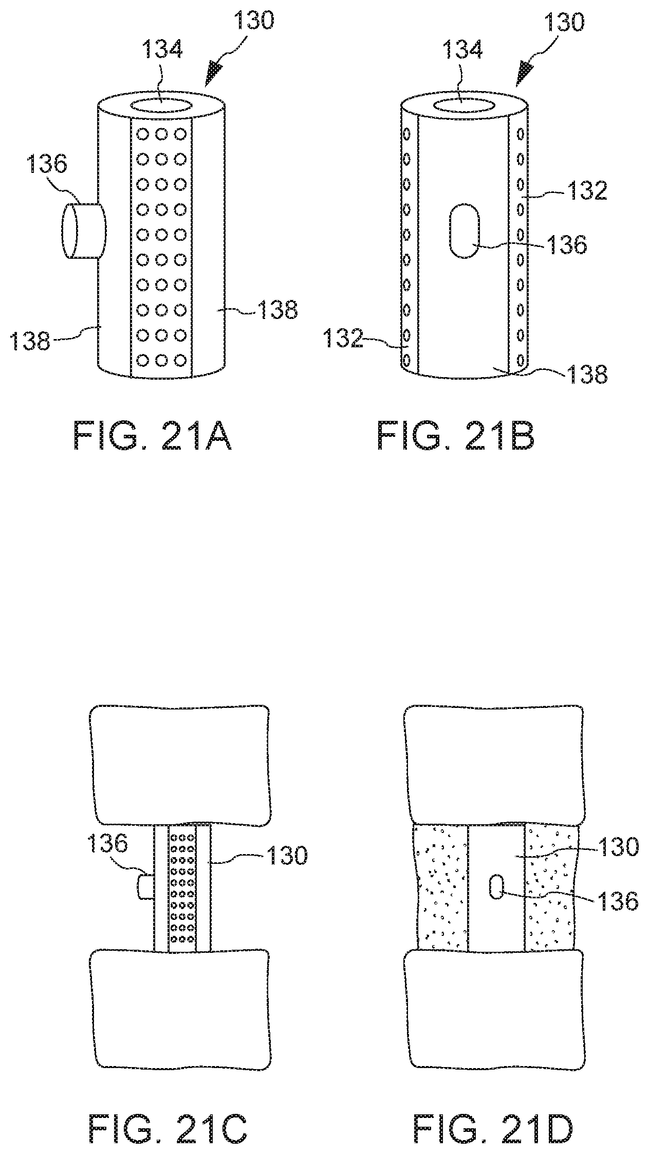 Patent US12611315 Figure 13 – Bone graft delivery system and method for using same