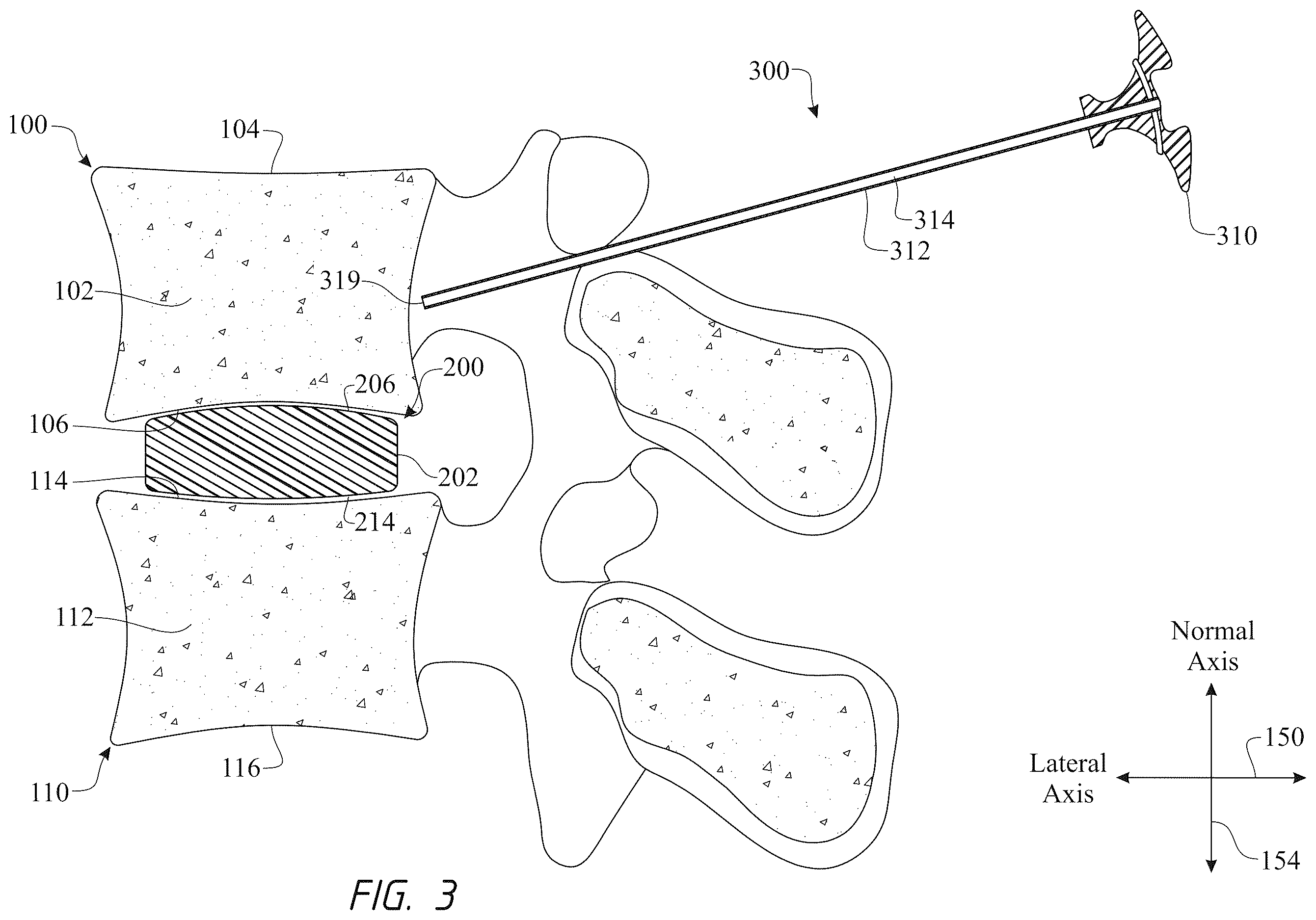 Patent US12611316 Figure 3 – Intervertebral members and methods of using a bone reinforcing composition for retaining the intervertebral members