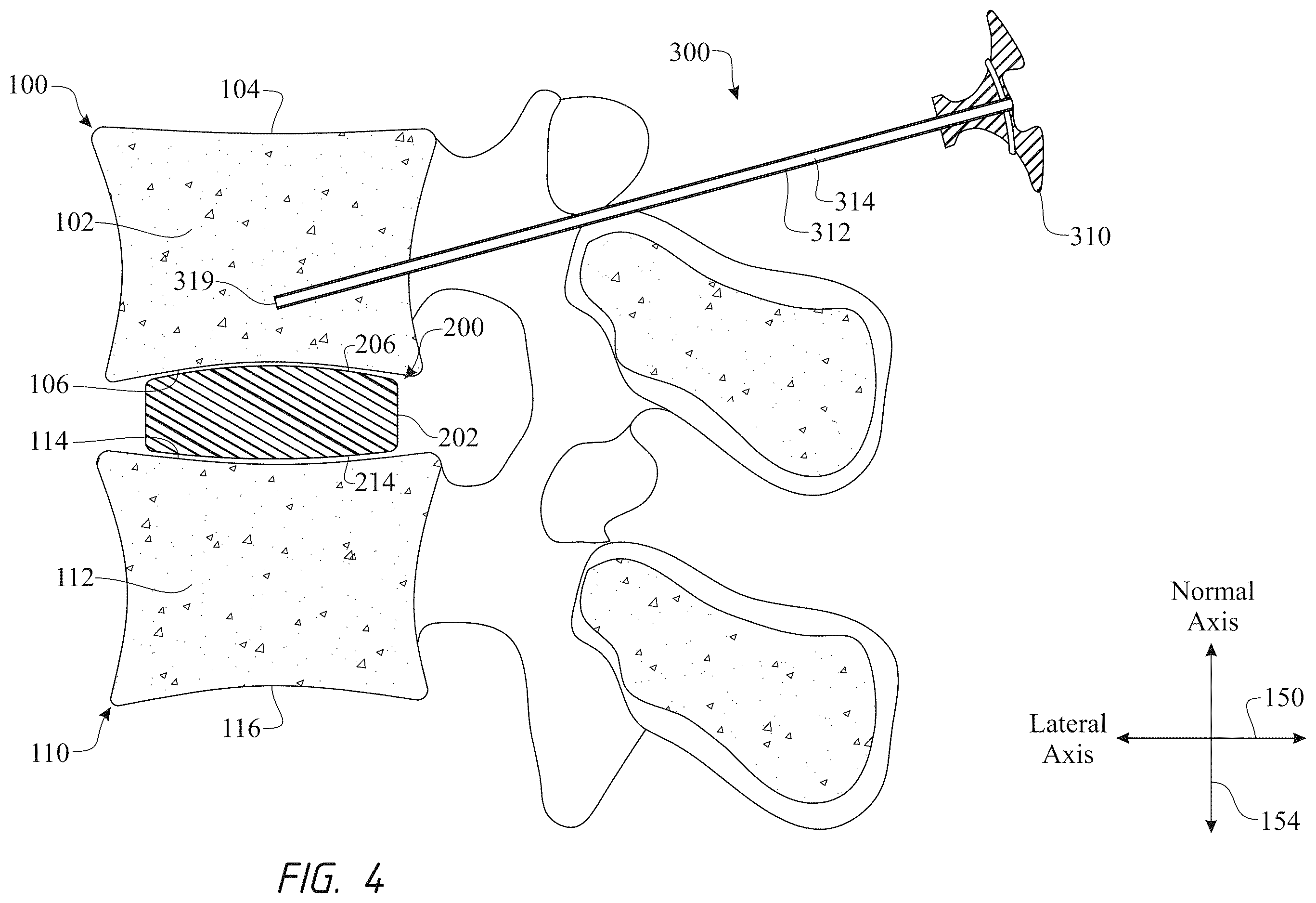 Patent US12611316 Figure 4 – Intervertebral members and methods of using a bone reinforcing composition for retaining the intervertebral members