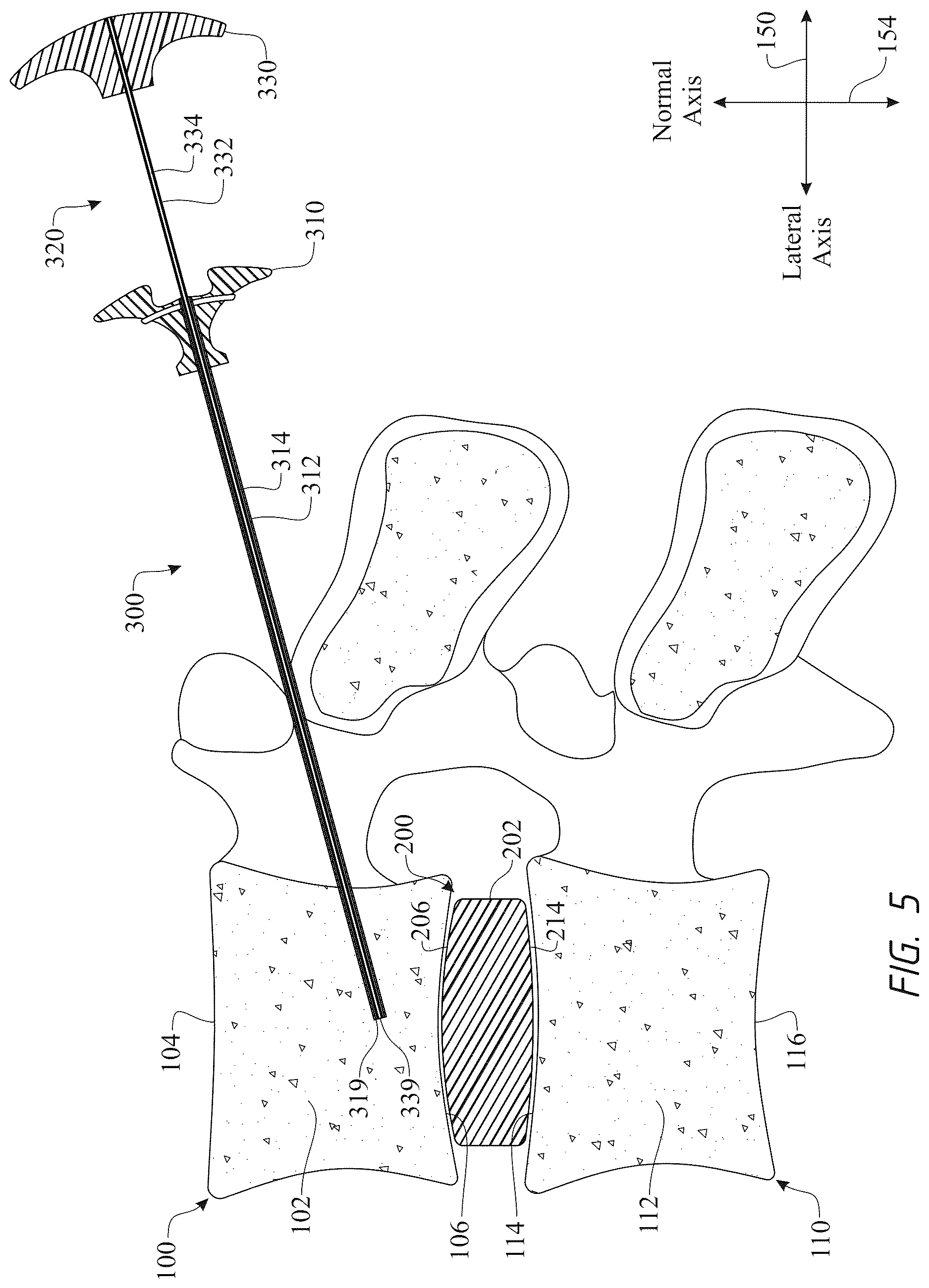 Patent US12611316 Figure 5 – Intervertebral members and methods of using a bone reinforcing composition for retaining the intervertebral members
