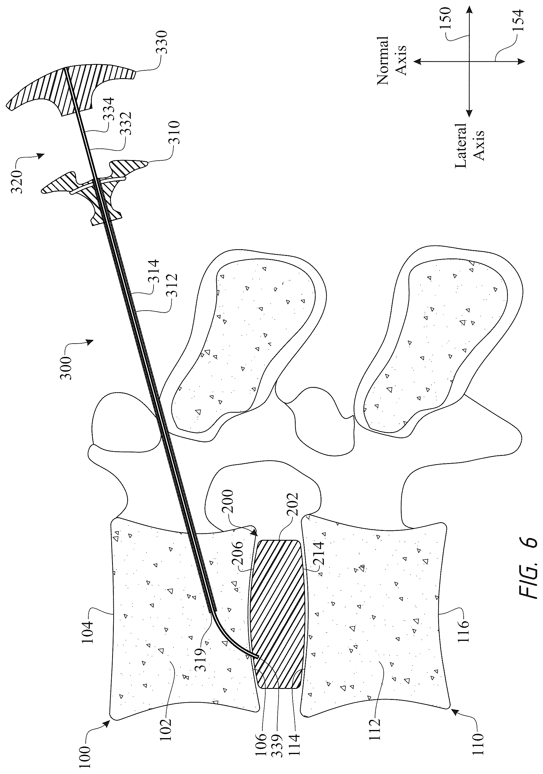 Patent US12611316 Figure 6 – Intervertebral members and methods of using a bone reinforcing composition for retaining the intervertebral members