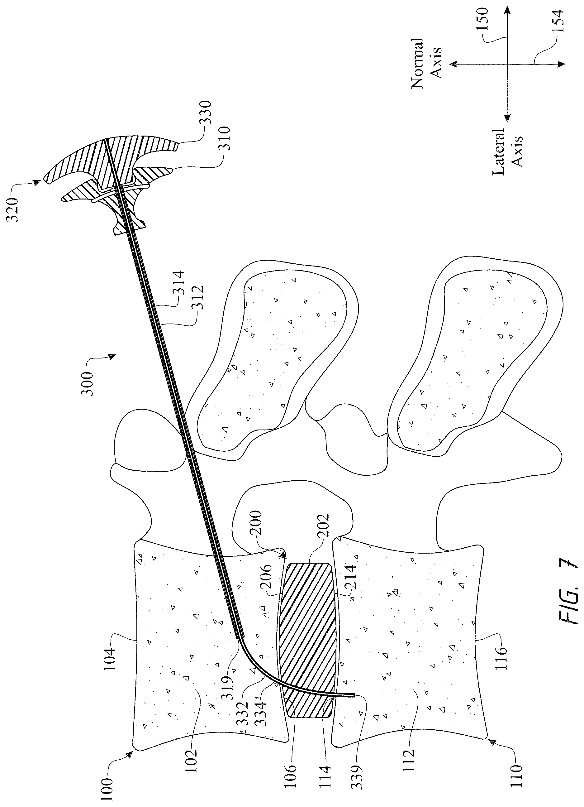 Patent US12611316 Figure 7 – Intervertebral members and methods of using a bone reinforcing composition for retaining the intervertebral members