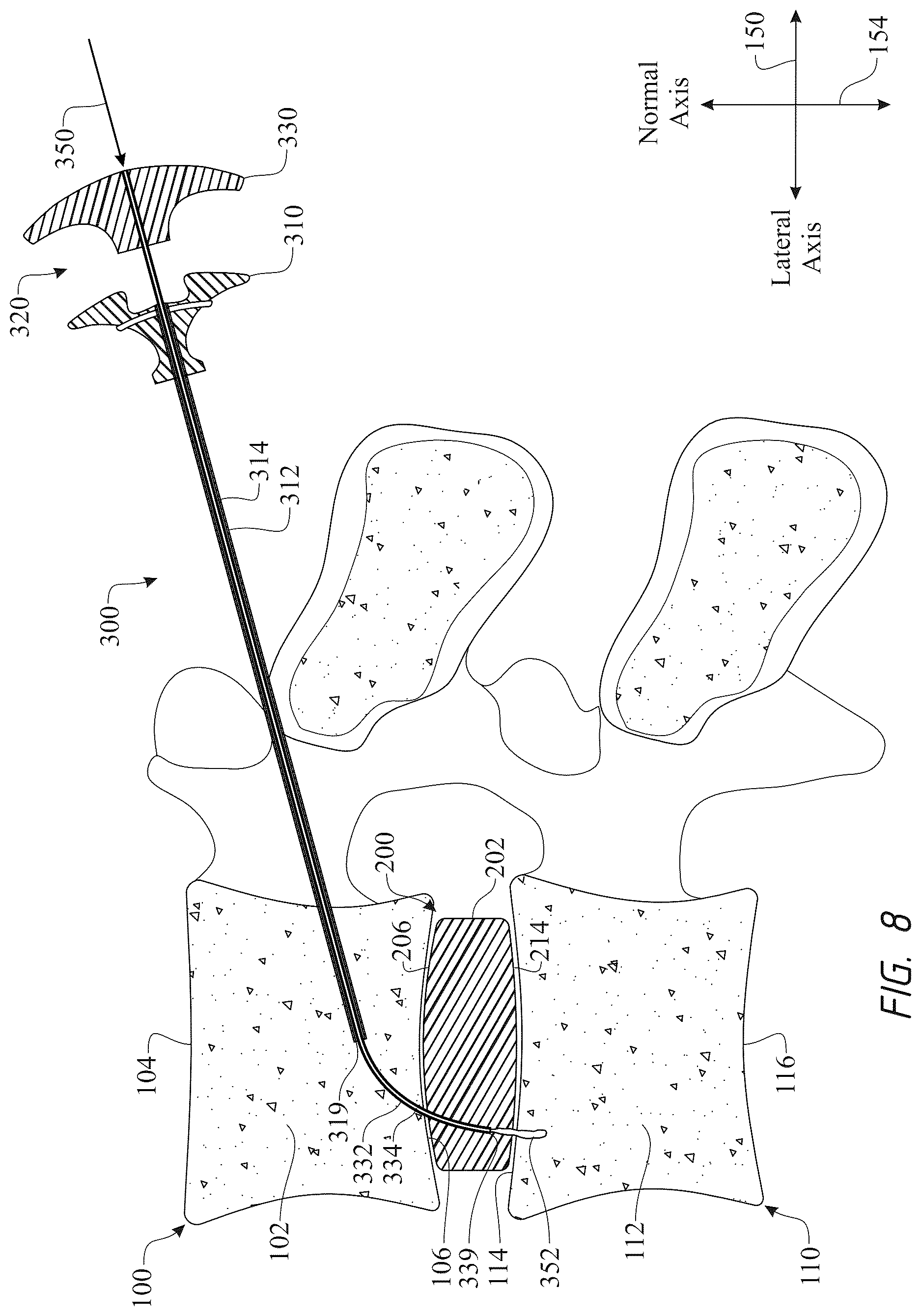 Patent US12611316 Figure 8 – Intervertebral members and methods of using a bone reinforcing composition for retaining the intervertebral members
