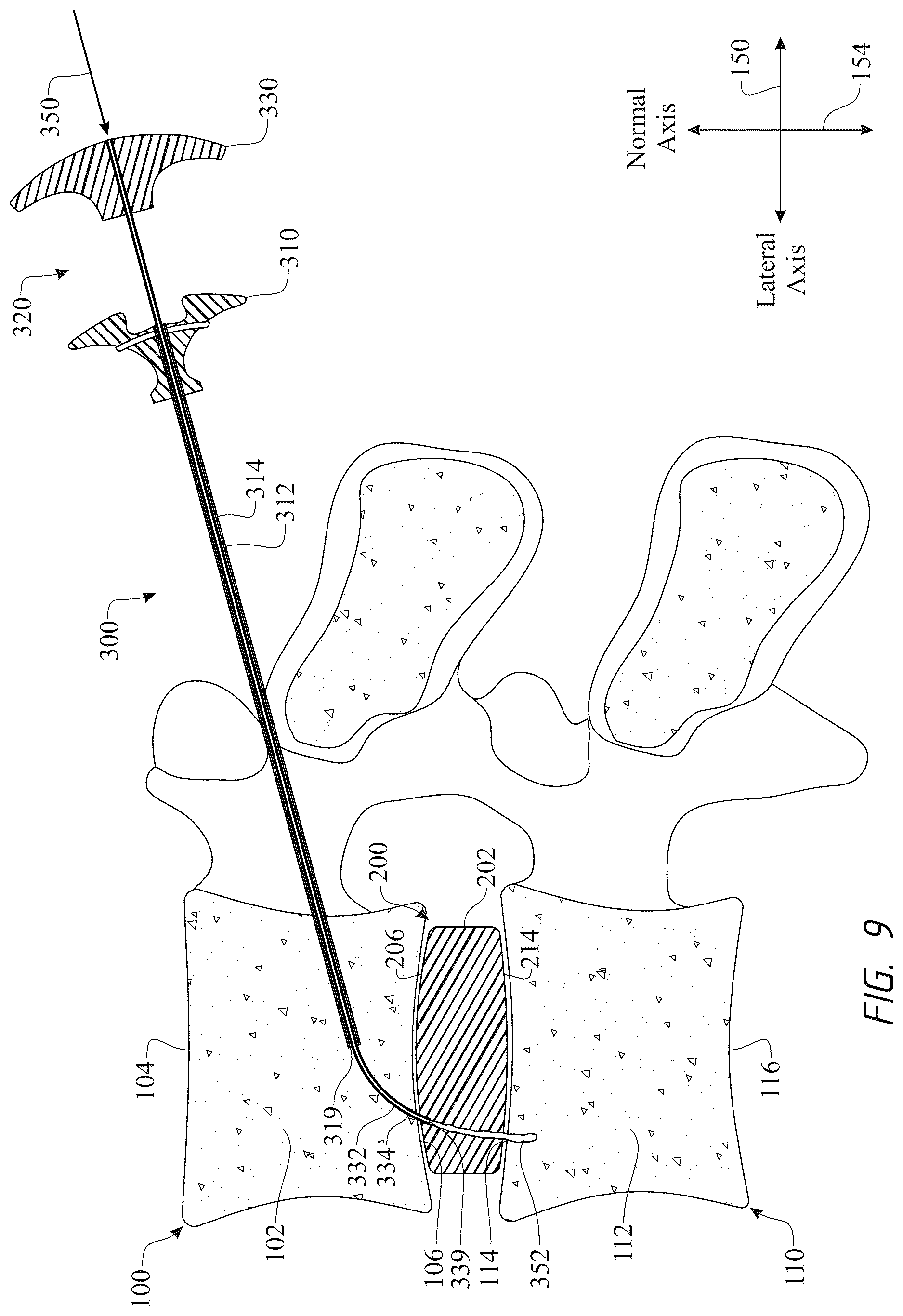 Patent US12611316 Figure 9 – Intervertebral members and methods of using a bone reinforcing composition for retaining the intervertebral members
