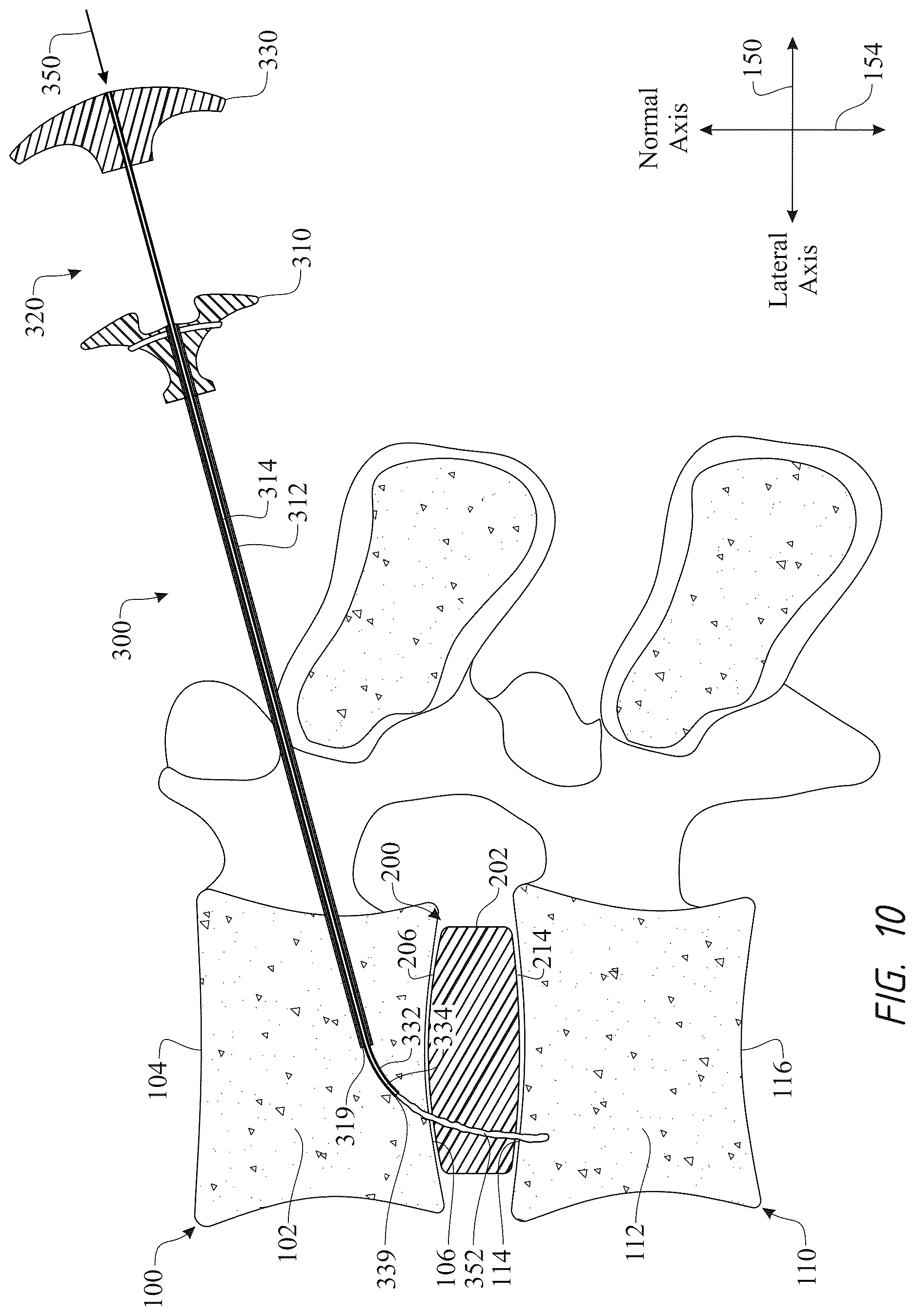 Patent US12611316 Figure 10 – Intervertebral members and methods of using a bone reinforcing composition for retaining the intervertebral members