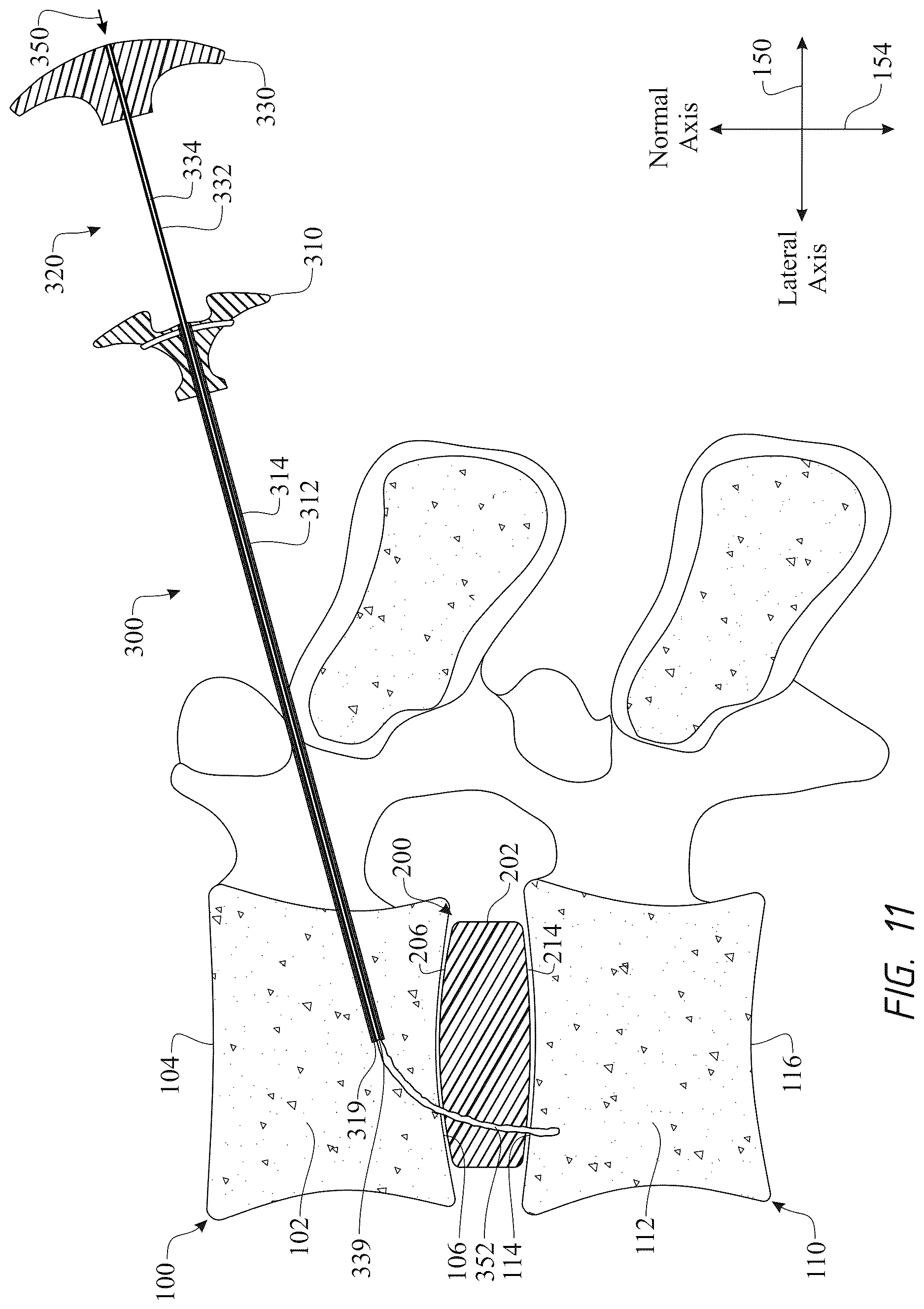 Patent US12611316 Figure 11 – Intervertebral members and methods of using a bone reinforcing composition for retaining the intervertebral members