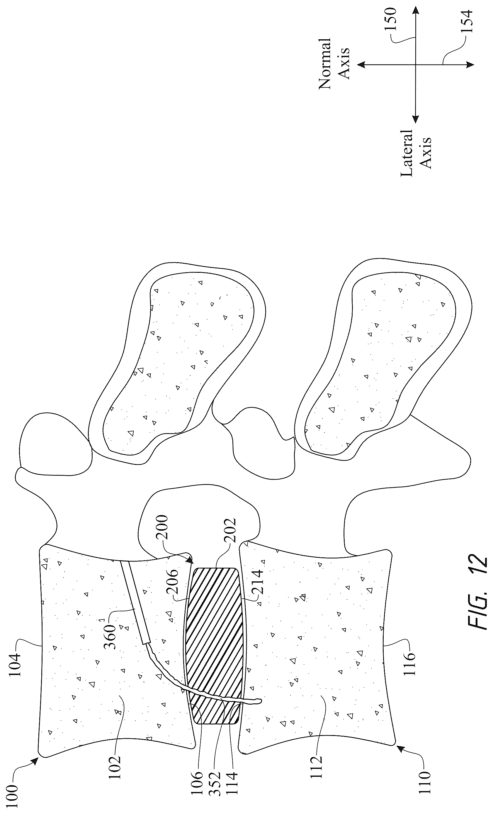 Patent US12611316 Figure 12 – Intervertebral members and methods of using a bone reinforcing composition for retaining the intervertebral members