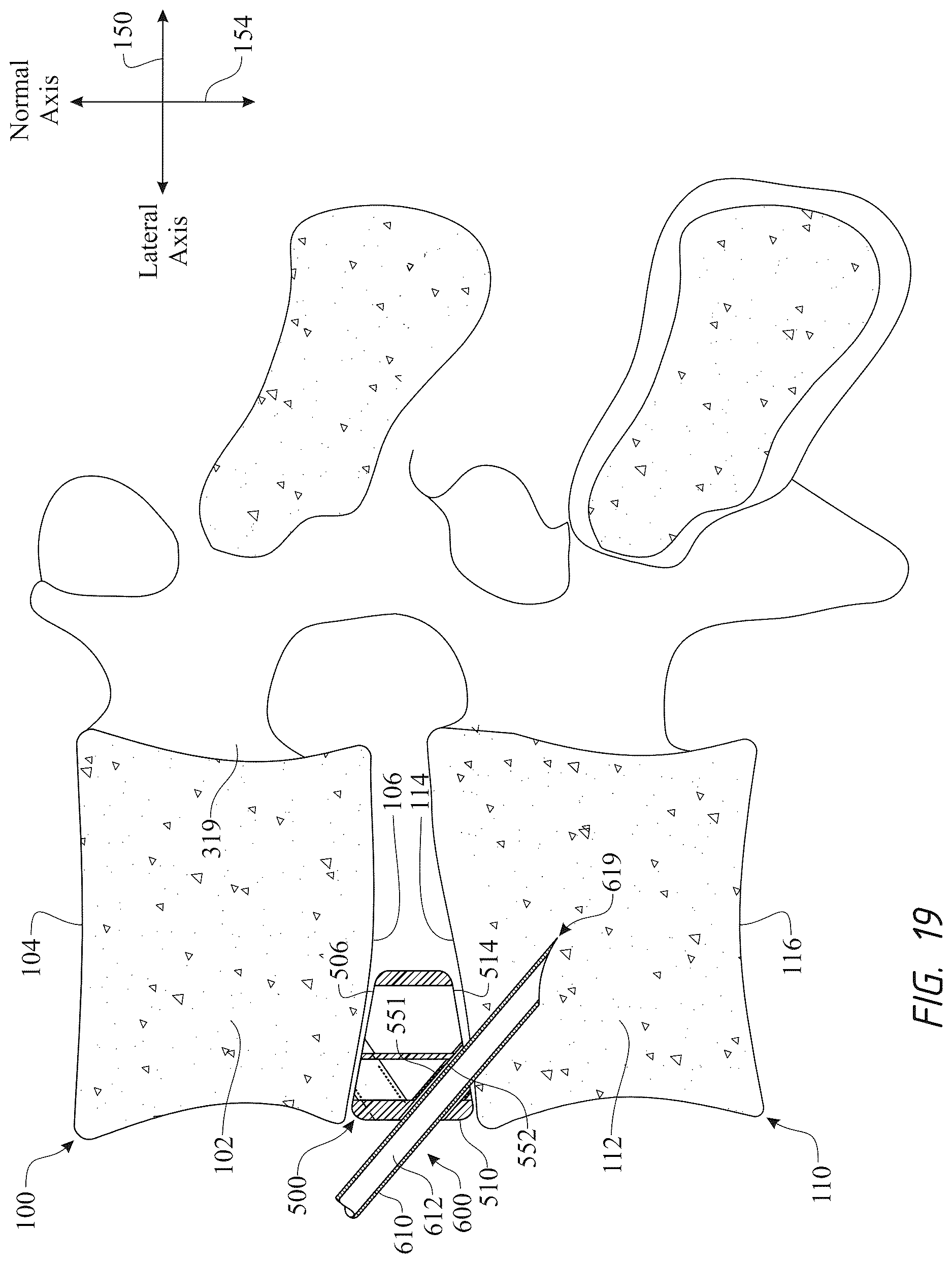 Patent US12611316 Figure 19 – Intervertebral members and methods of using a bone reinforcing composition for retaining the intervertebral members