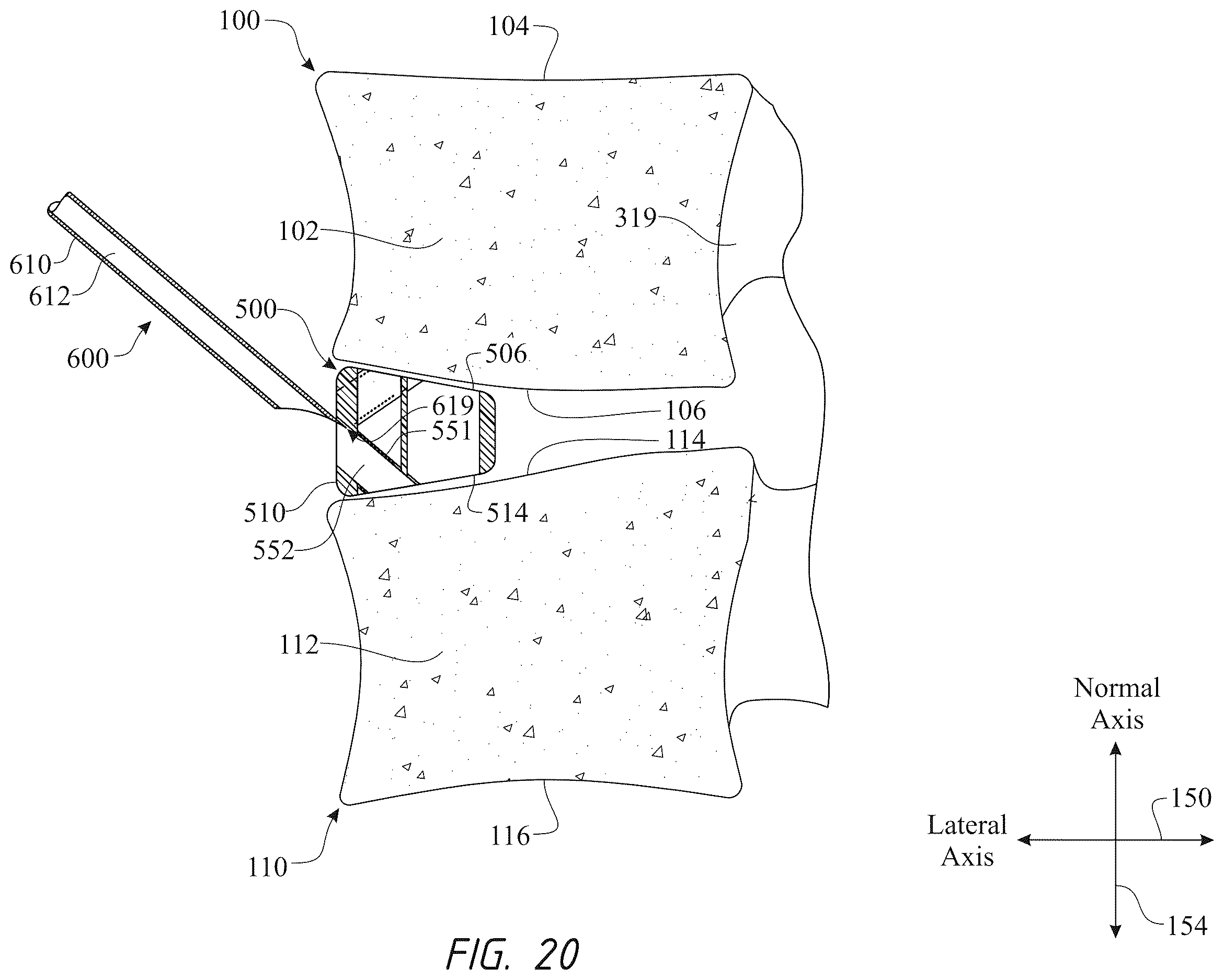 Patent US12611316 Figure 20 – Intervertebral members and methods of using a bone reinforcing composition for retaining the intervertebral members