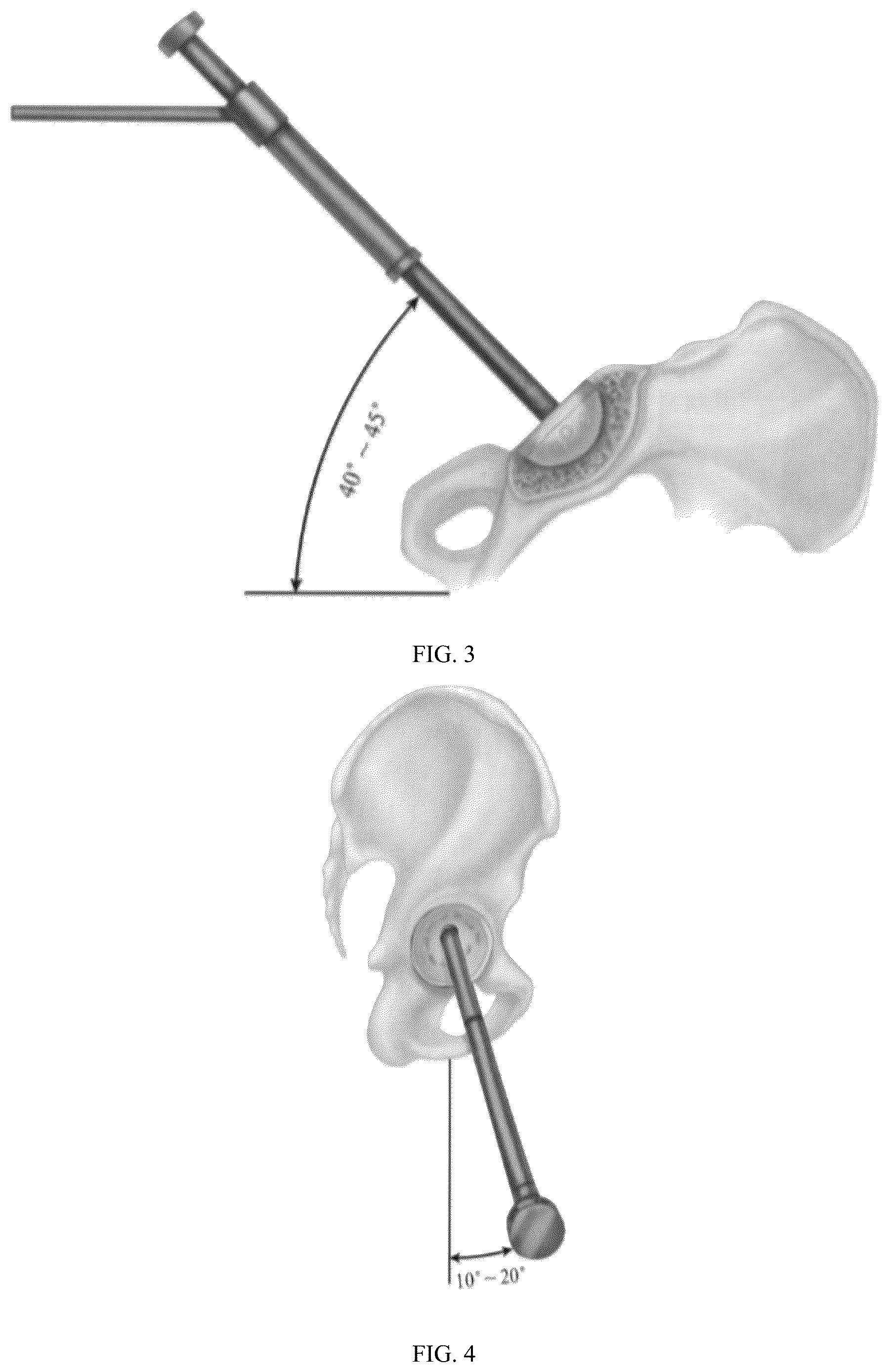 Patent US12611320 Figure 3 – Acetabular prosthesis angle positioning device and method for total hip arthroplasty