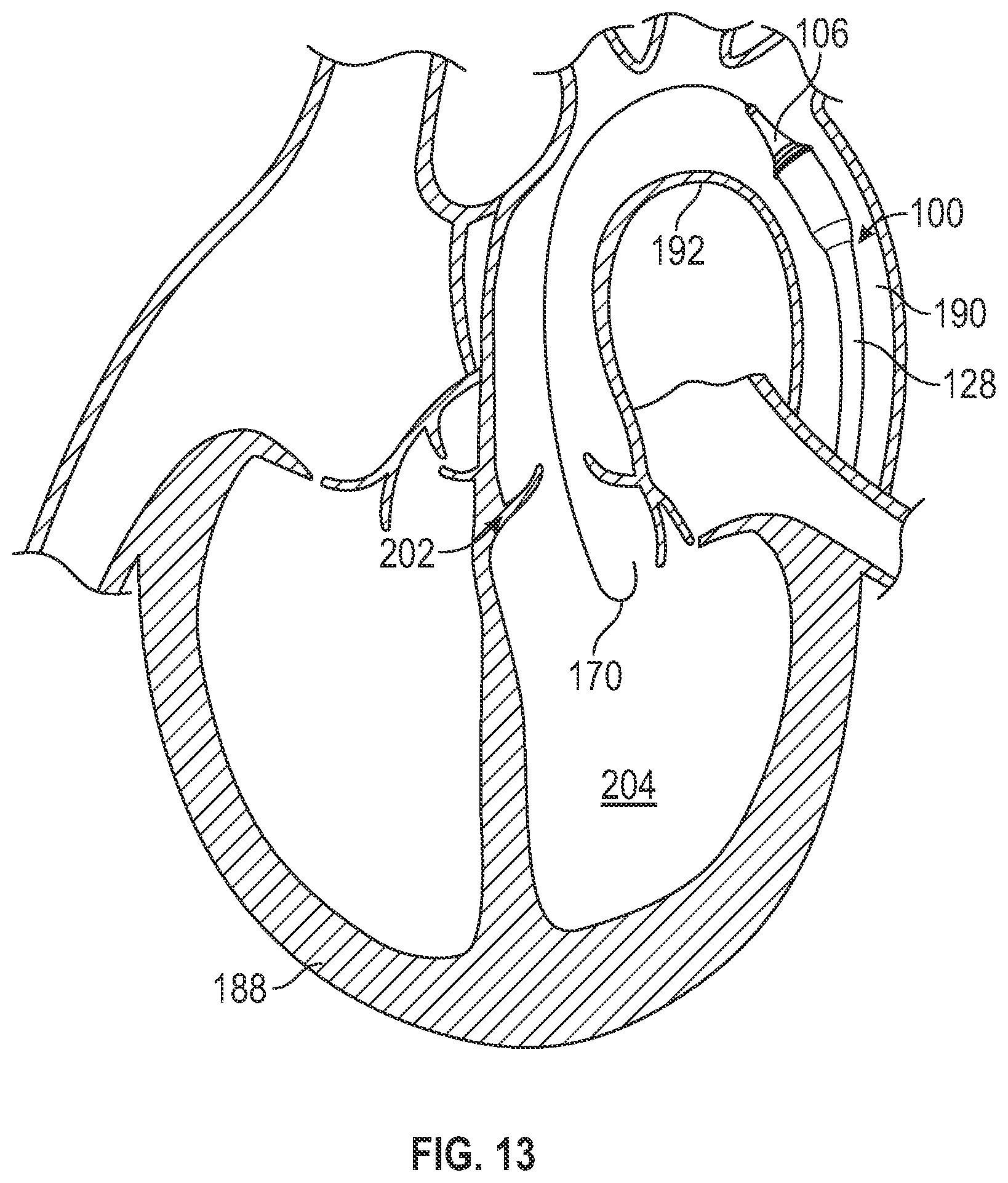 Patent US12611321 Figure 8 – Delivery apparatus having nosecone with pivotable end portion