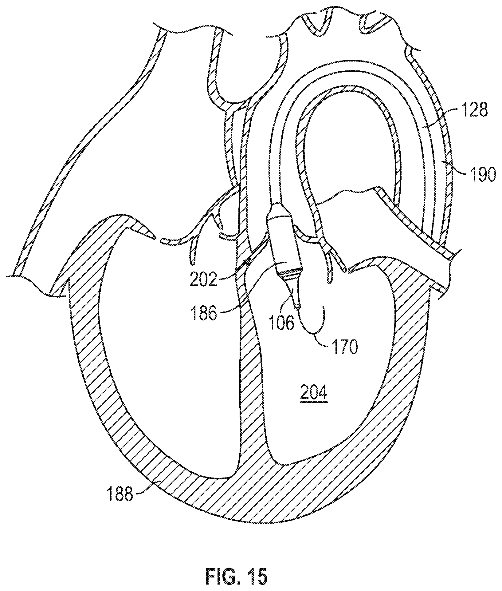 Patent US12611321 Figure 10 – Delivery apparatus having nosecone with pivotable end portion