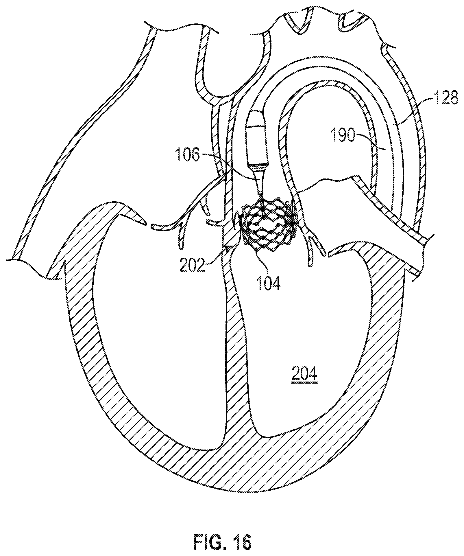 Patent US12611321 Figure 11 – Delivery apparatus having nosecone with pivotable end portion