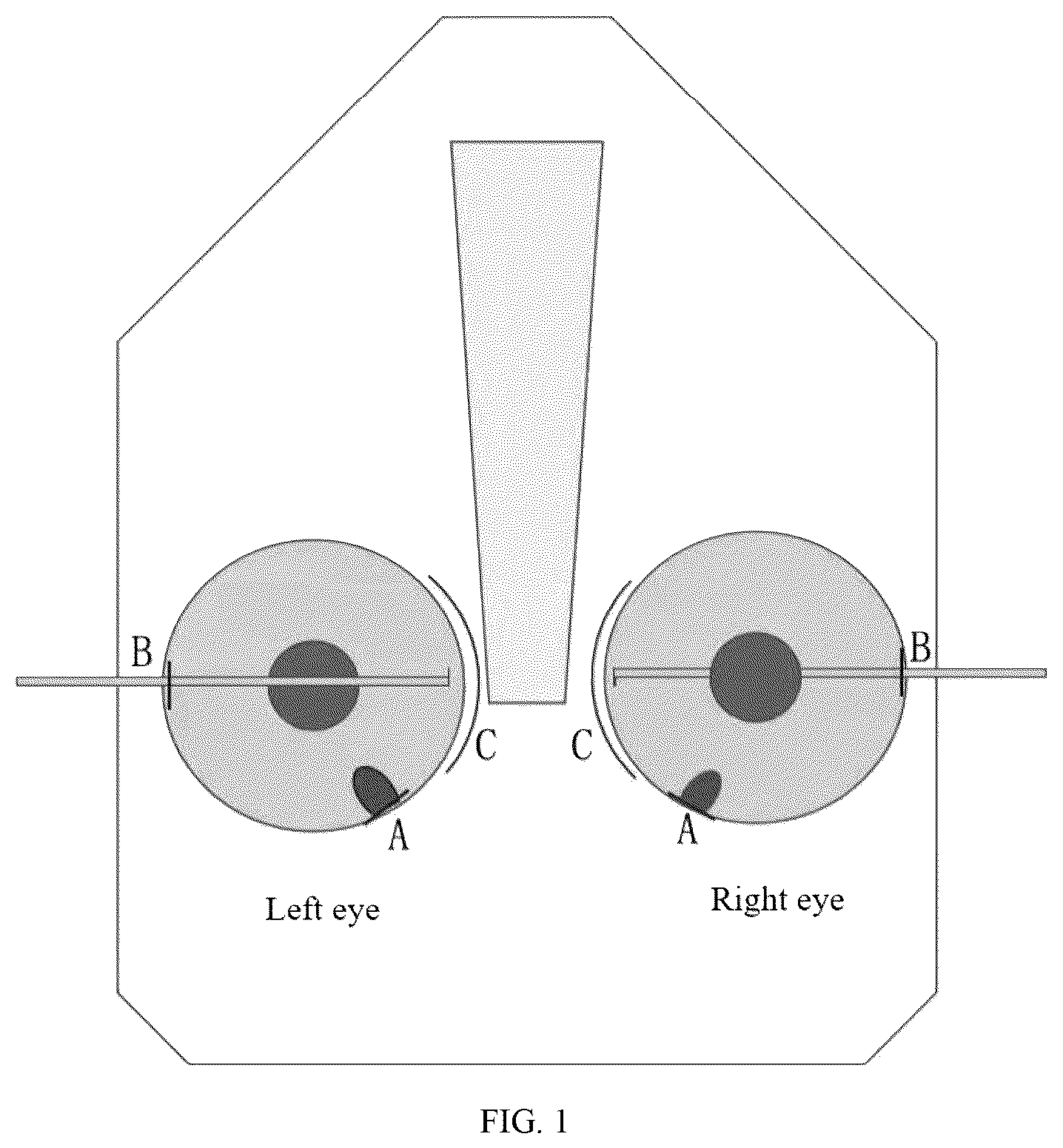 Patent US12611331 Figure 1 – Method for treating advanced primary angle closure glaucoma
