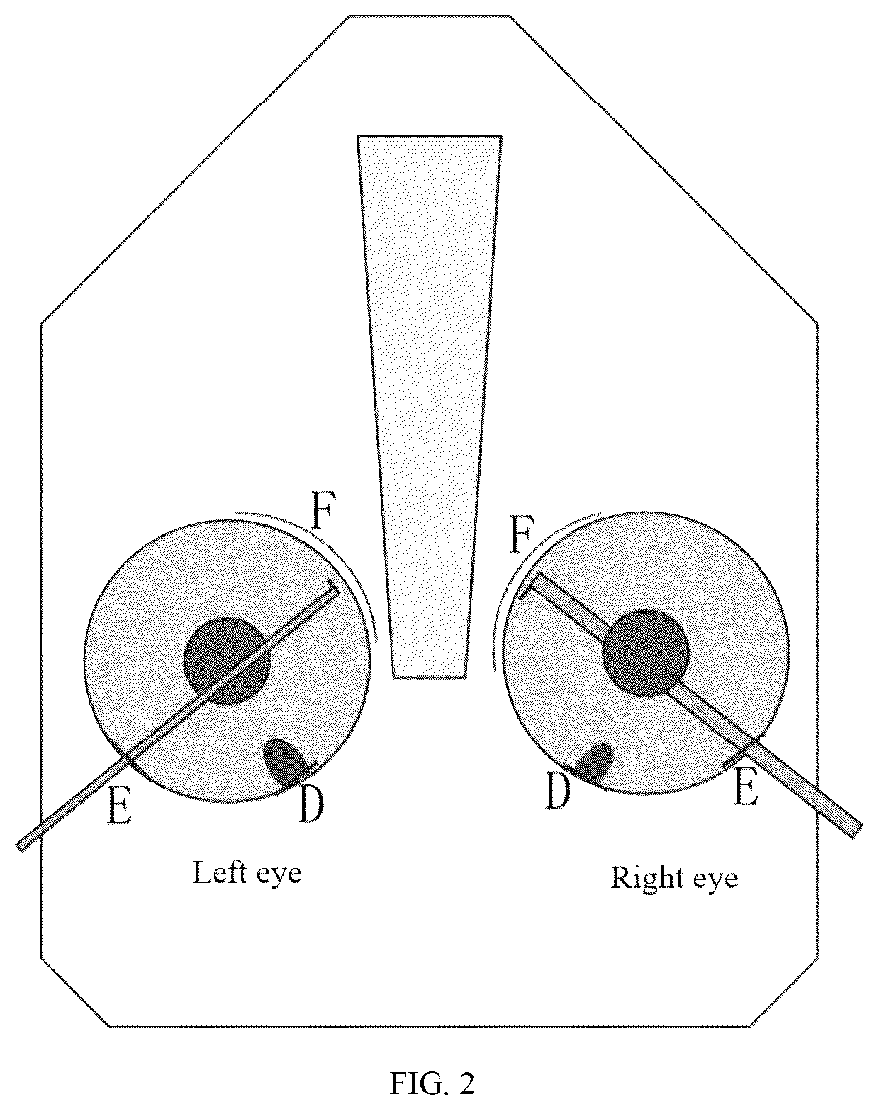 Patent US12611331 Figure 2 – Method for treating advanced primary angle closure glaucoma