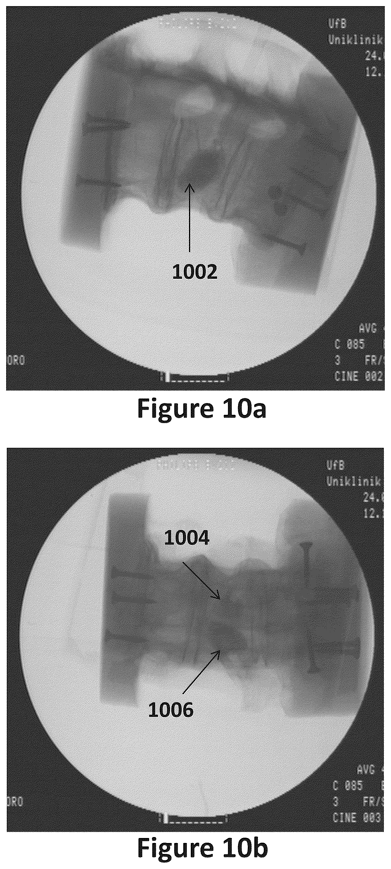 Patent US12611483 Figure 11 – Implant comprising a plurality of hardening states
