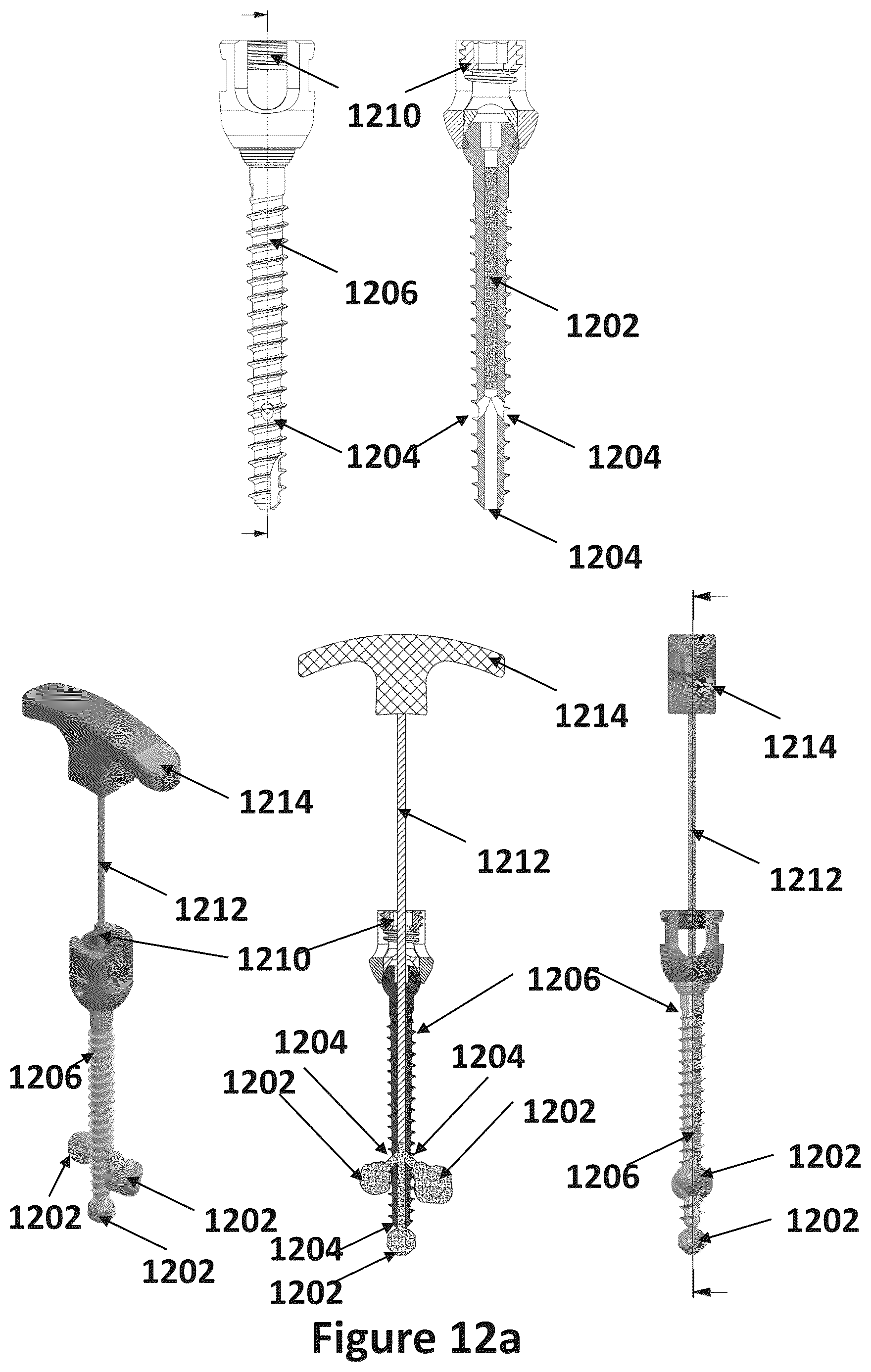 Patent US12611483 Figure 14 – Implant comprising a plurality of hardening states