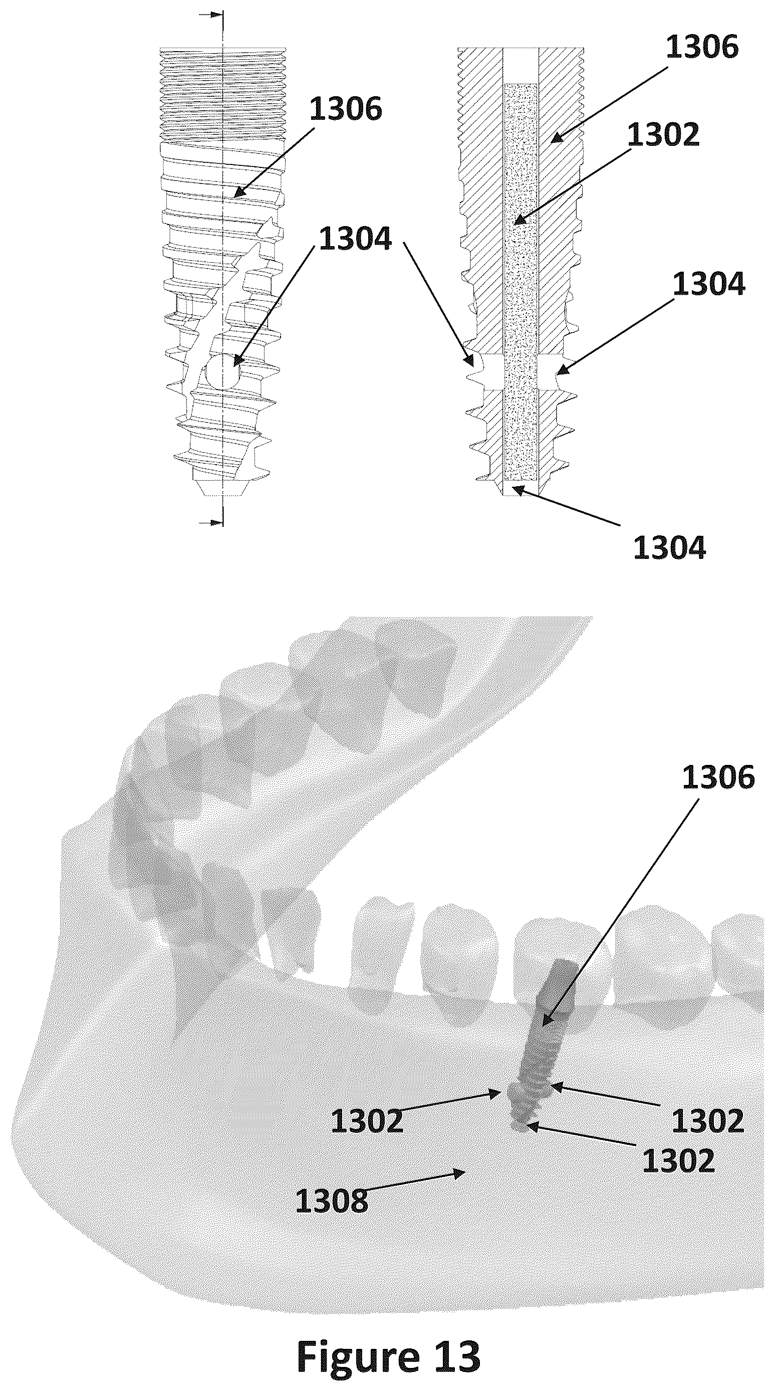 Patent US12611483 Figure 16 – Implant comprising a plurality of hardening states