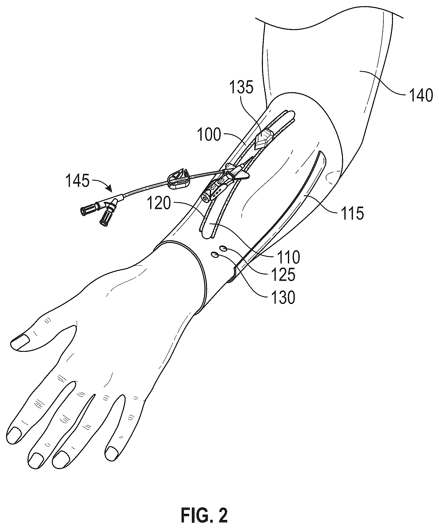 Patent US12611512 Figure 2 – Catheter placement device and related methods