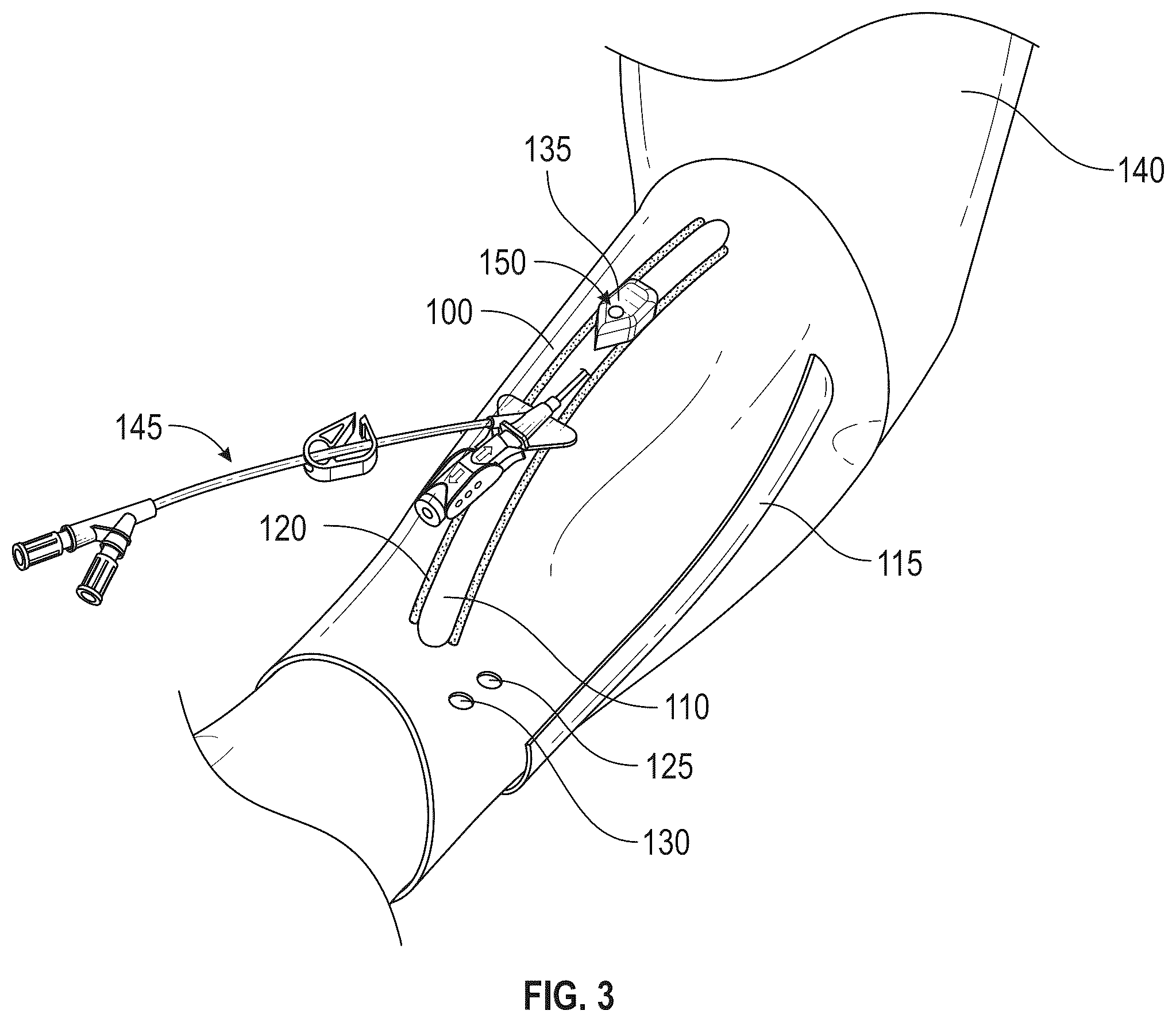 Patent US12611512 Figure 3 – Catheter placement device and related methods