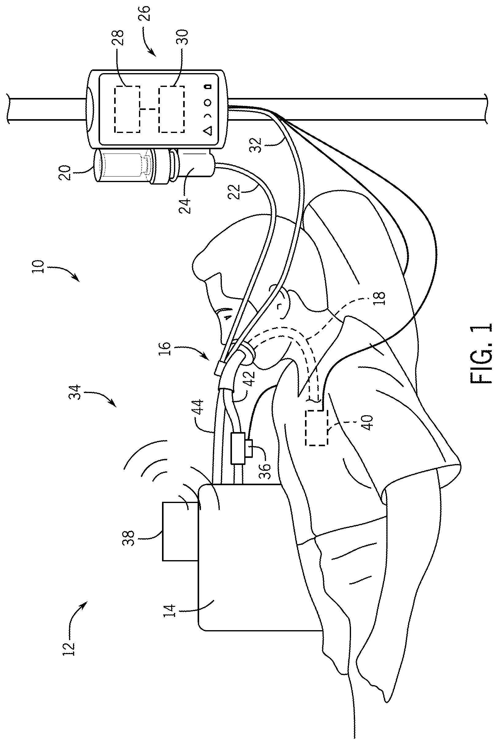 Patent US12611513 Figure 1 – Aerosol delivery system and method