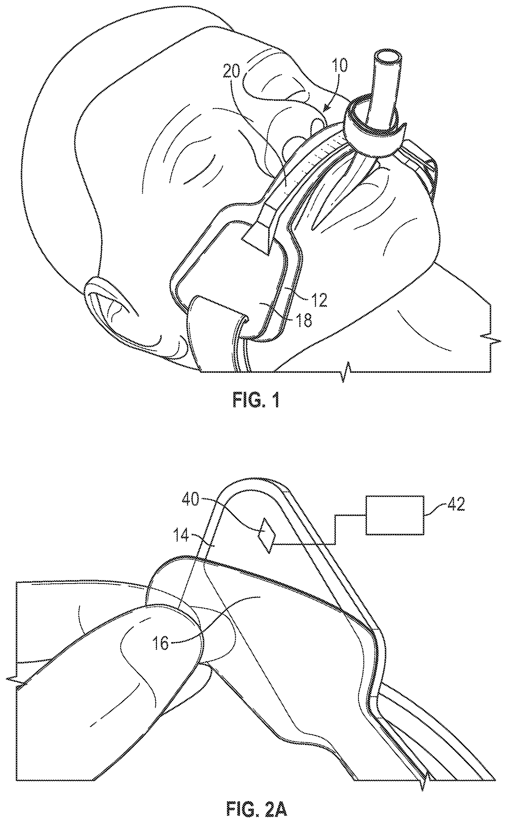 Patent US12611515 — Endotracheal tube holder — Figure 1