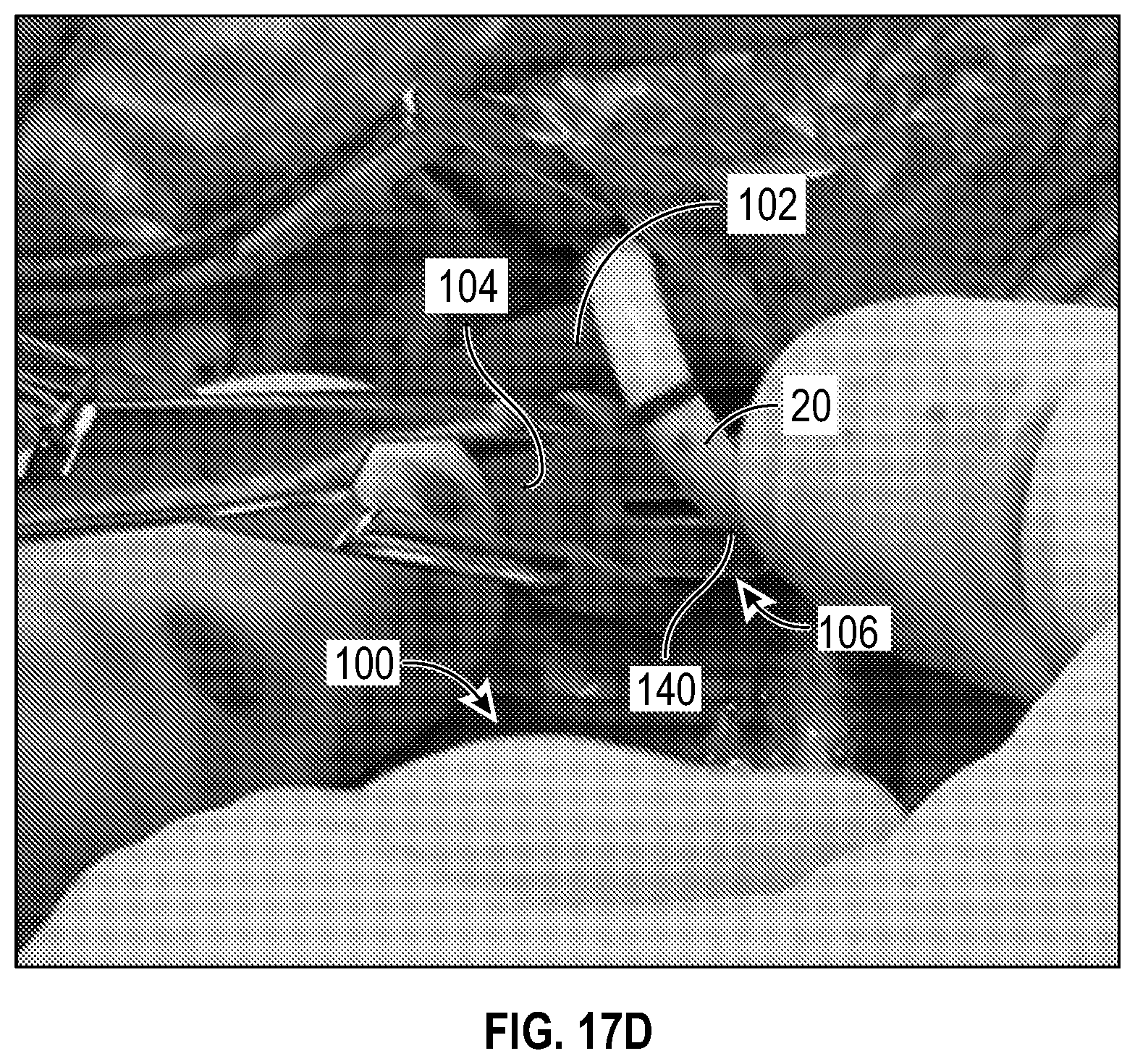 Patent US12611524 Figure 16 – Systems and methods for a catheter stabilization and occluder apparatus
