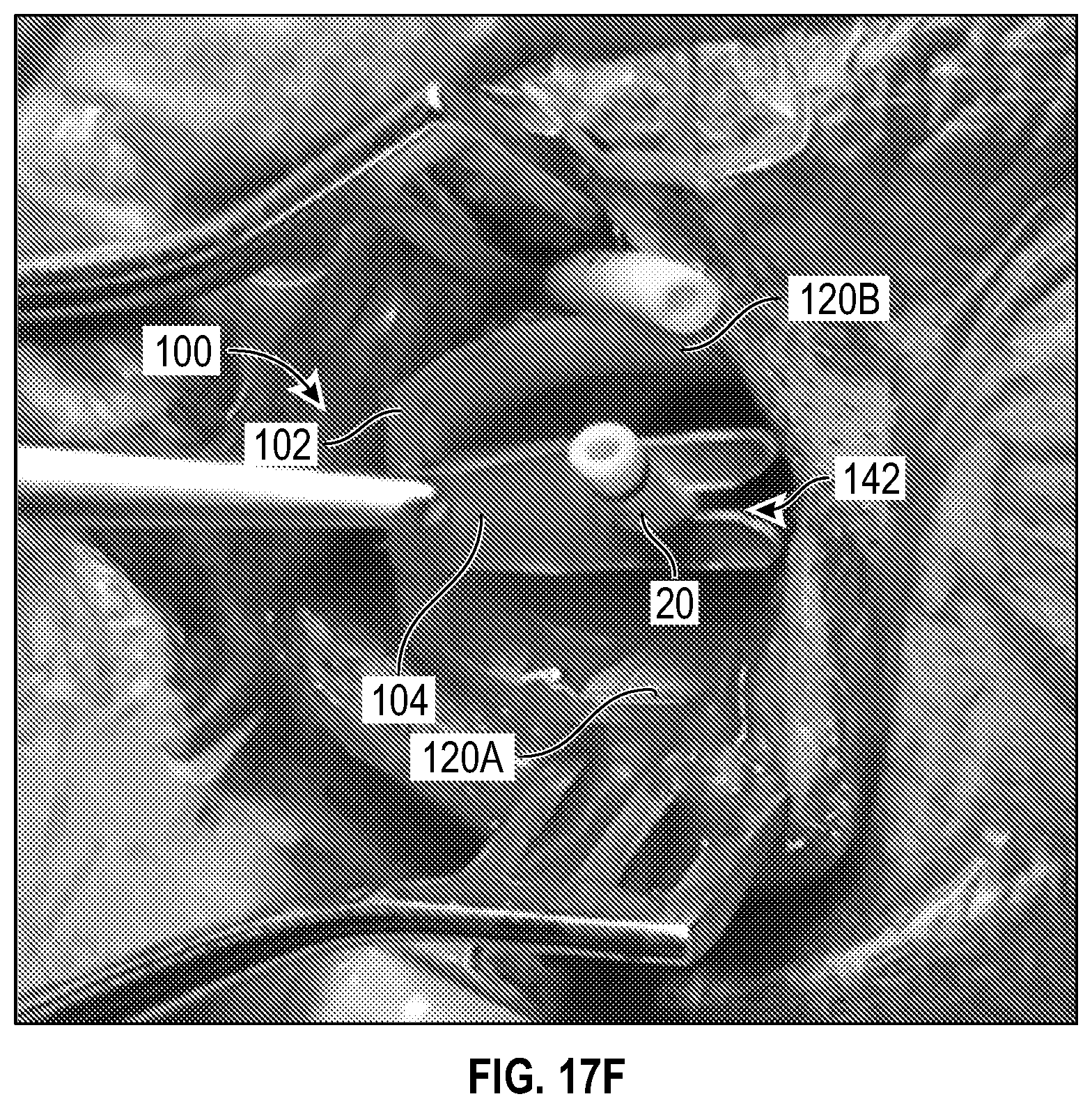 Patent US12611524 Figure 18 – Systems and methods for a catheter stabilization and occluder apparatus