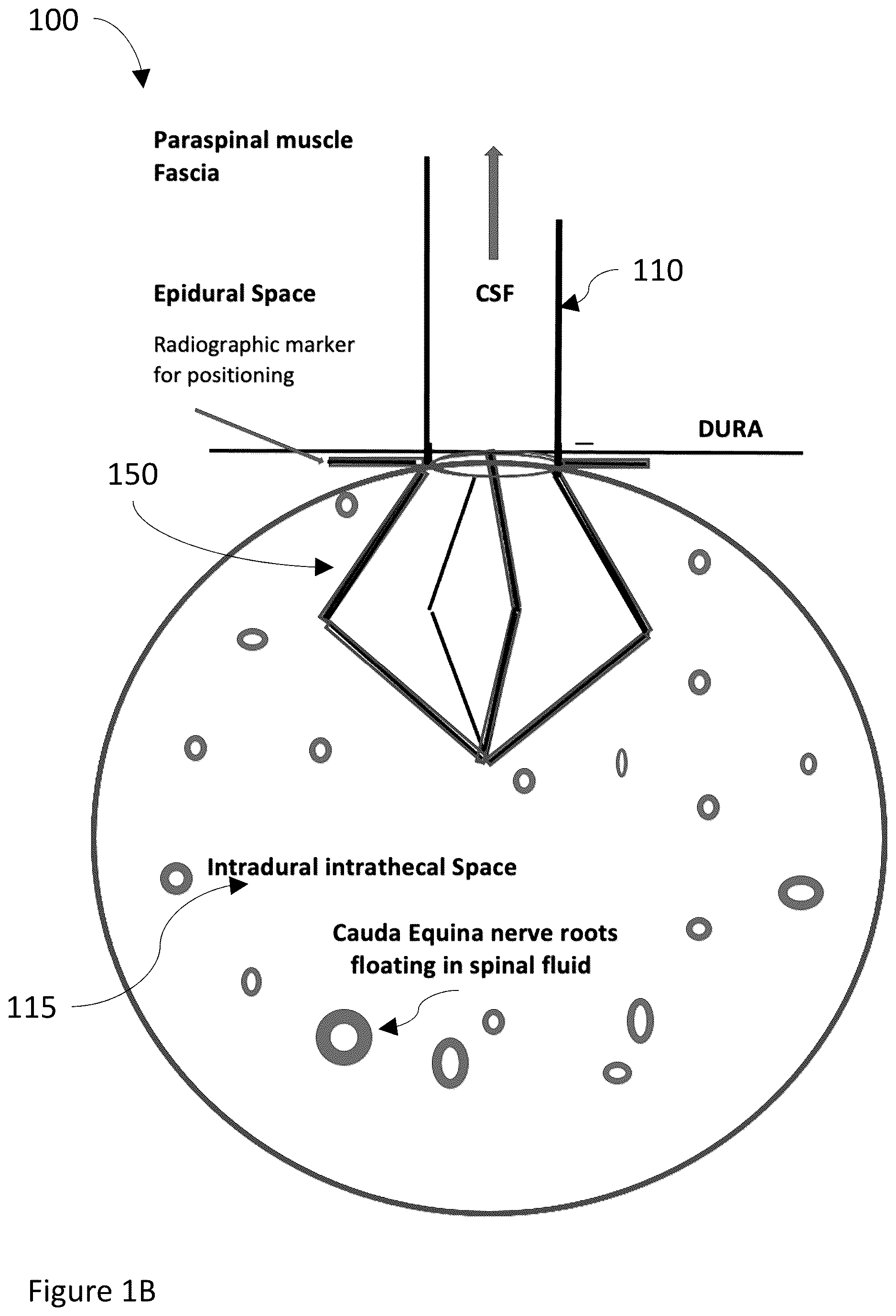 Patent US12611528 Figure 2 – Systems and methods for draining cerebrospinal fluid
