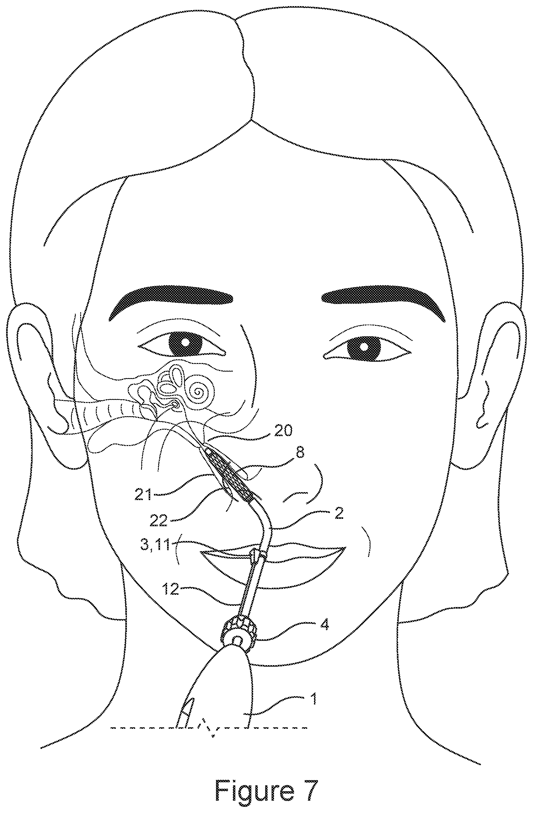 Patent US12611529 Figure 8 – Delivery device for eustachian tube procedures