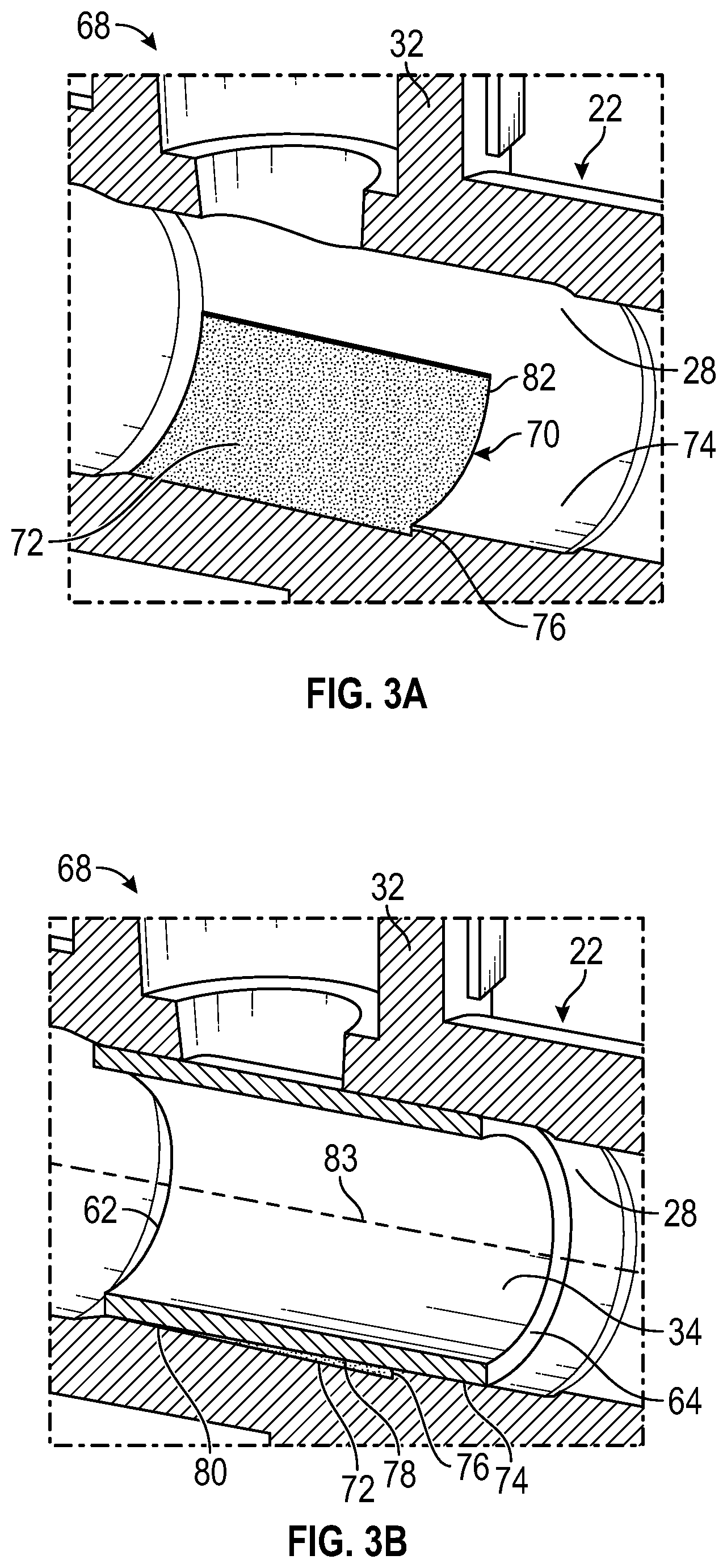 Patent US12611533 Figure 4 – Annular valve securement within a catheter assembly