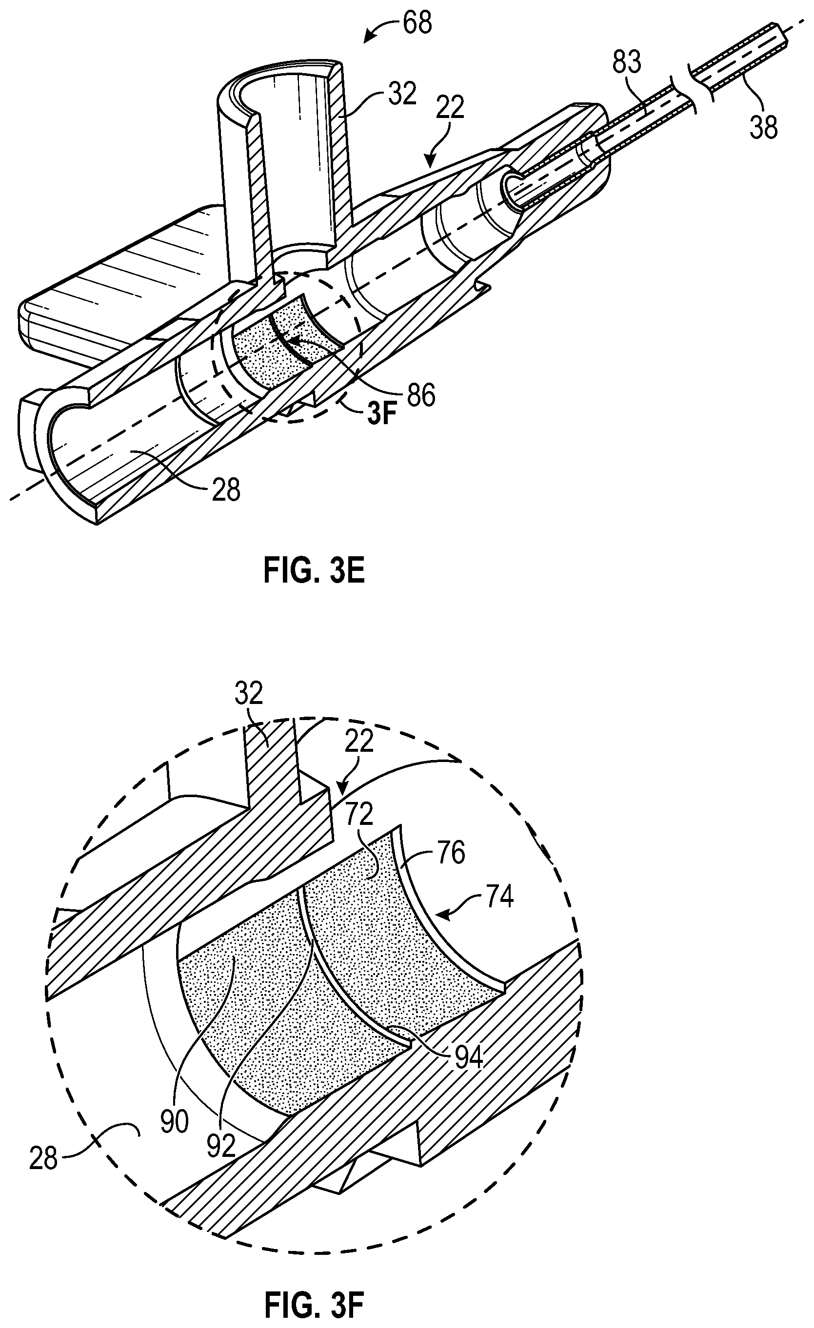 Patent US12611533 Figure 6 – Annular valve securement within a catheter assembly
