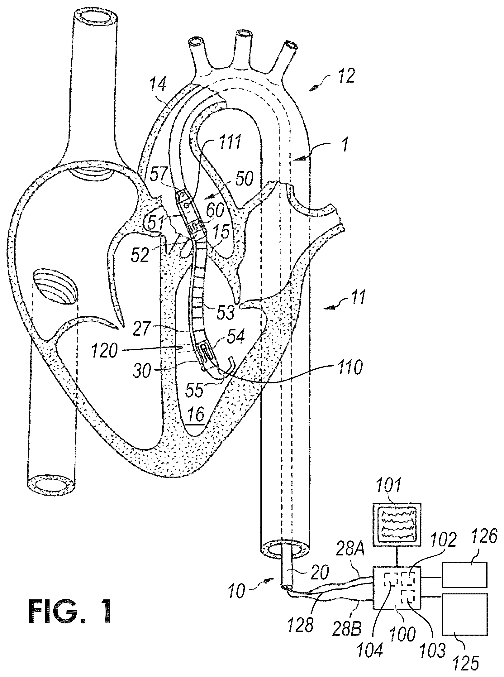 Patent US12611535 Figure 1 – Intravascular blood pump