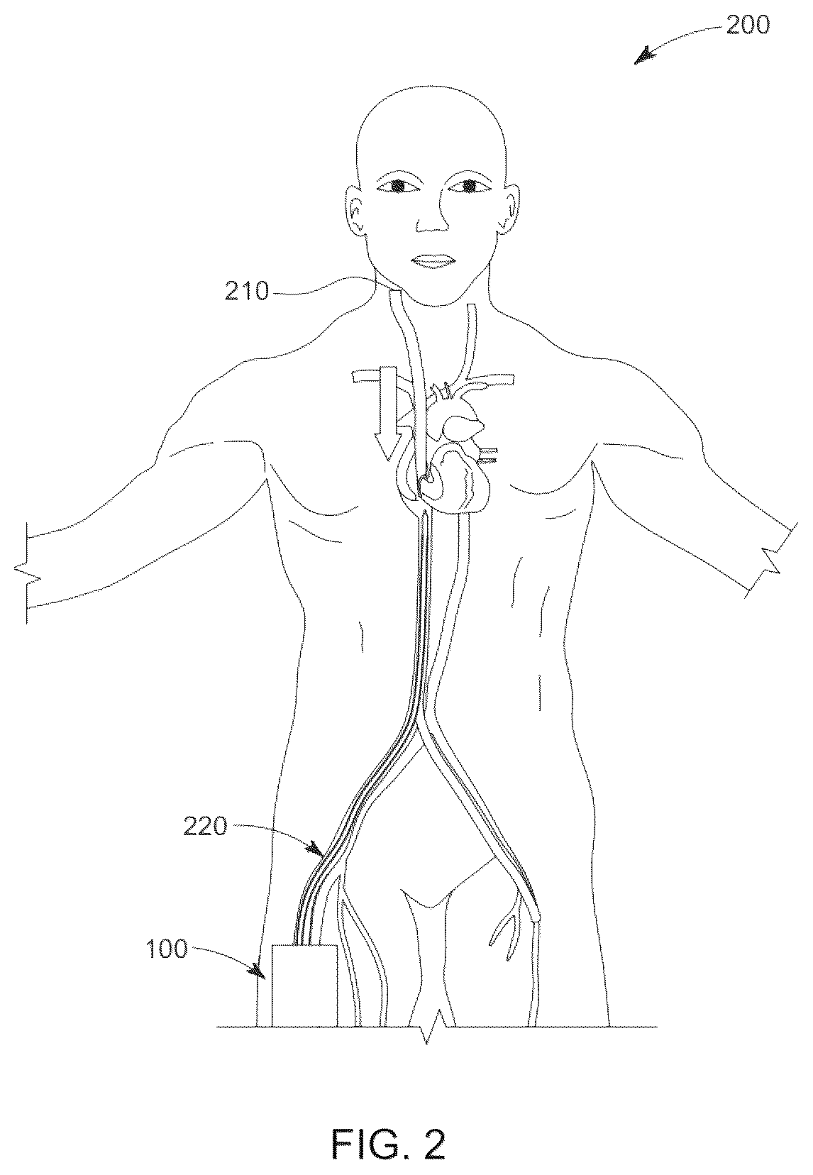Patent US12611536 Figure 2 – Catheter for membrane blood oxygenation