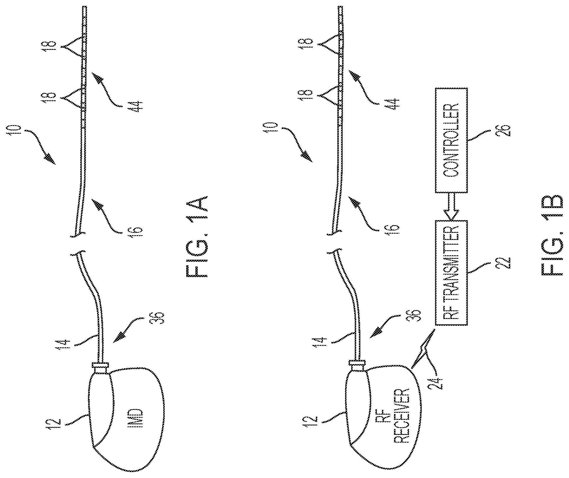 Patent US12611539 Figure 1 – Medical device lead tip anchor