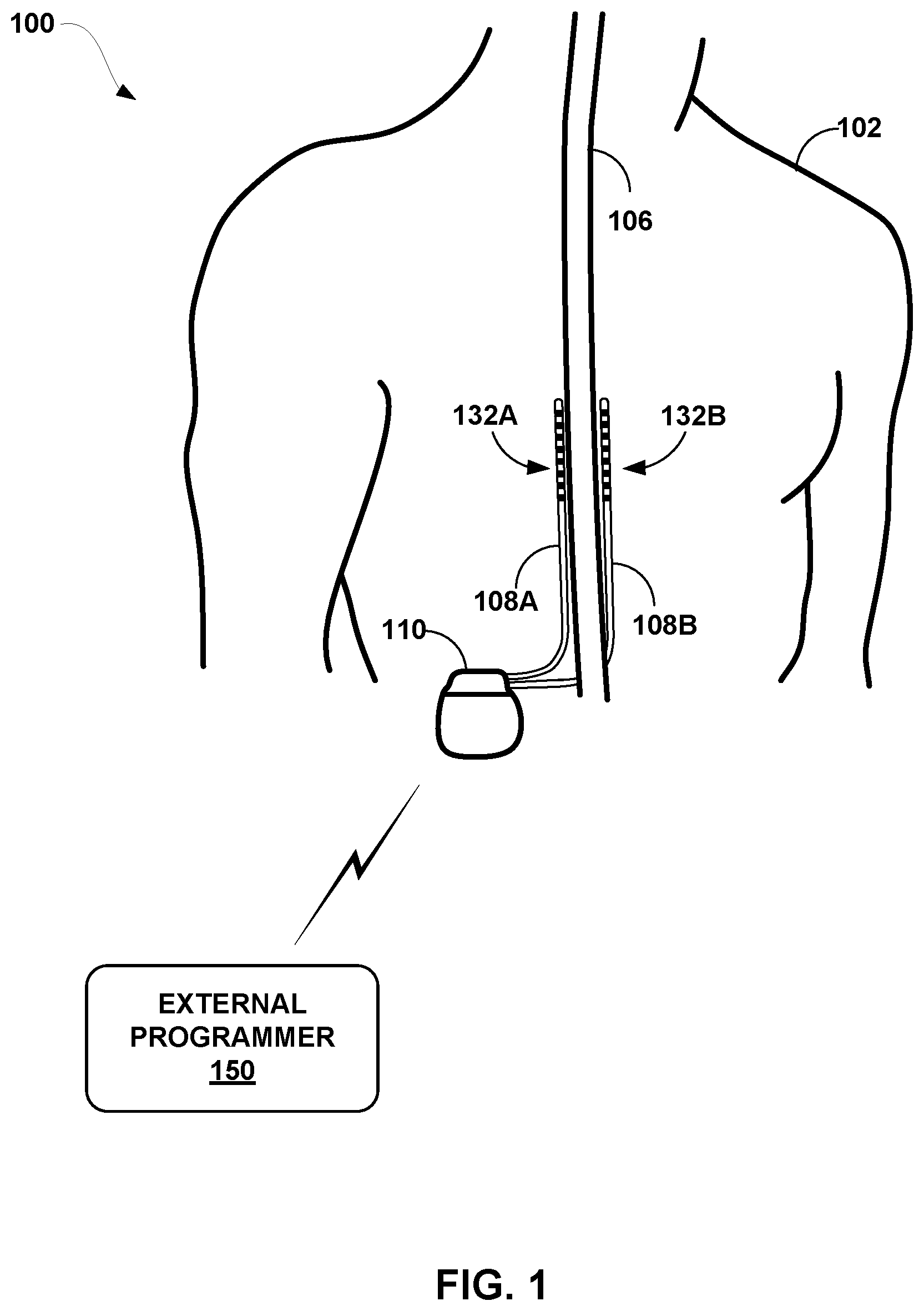 Patent US12611542 Figure 1 – Directional activation with electrical stimulation