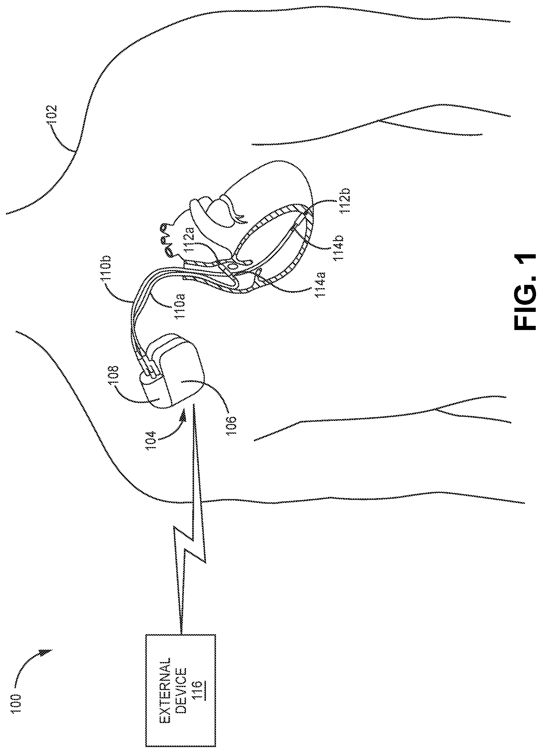 Patent US12611543 Figure 1 – Telemetry overuse reduction in a medical device