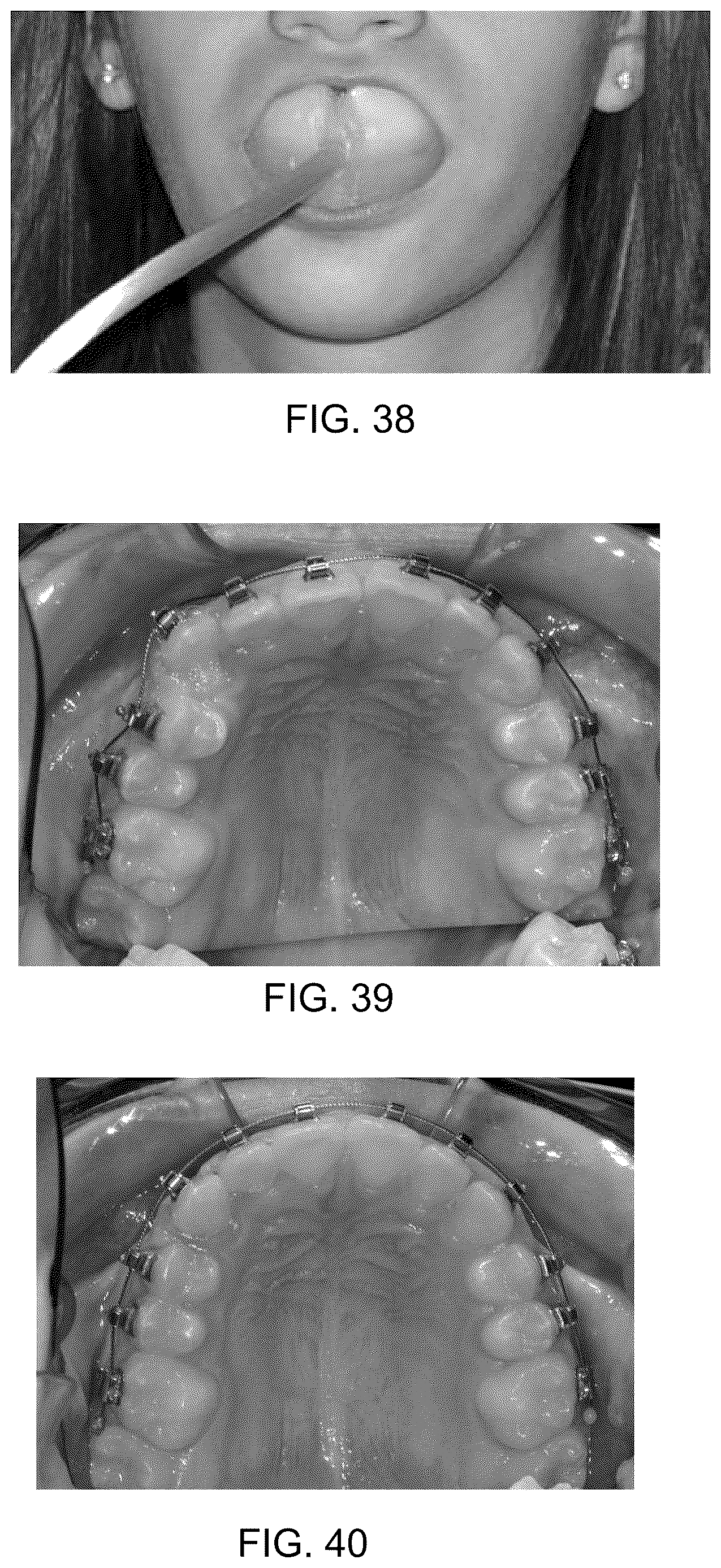 Patent US12611550 Figure 20 – Intra-oral light therapy apparatuses and methods for their use