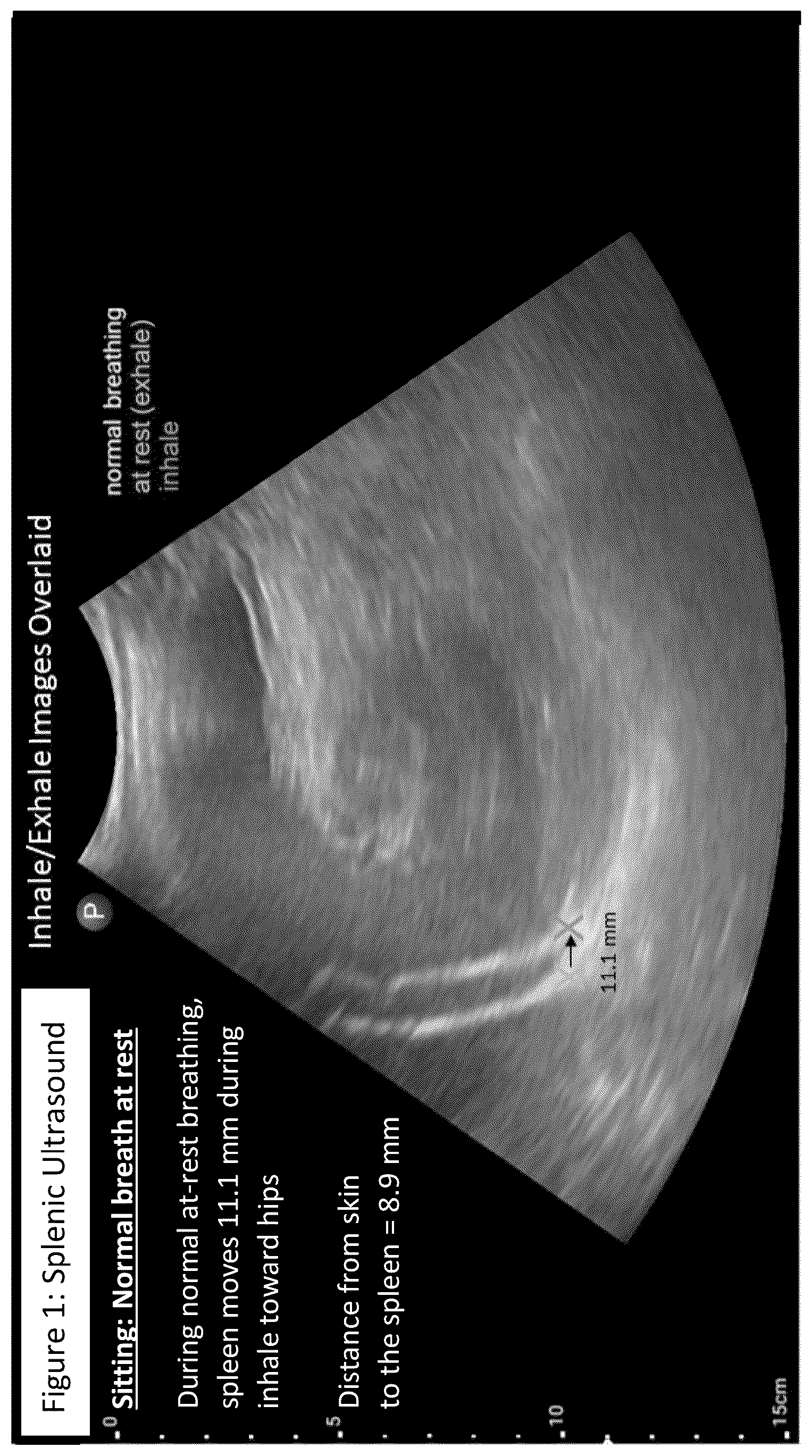 Patent US12611555 Figure 1 – Systems and methods for targeting an organ with ultrasound stimulation for treating inflammation